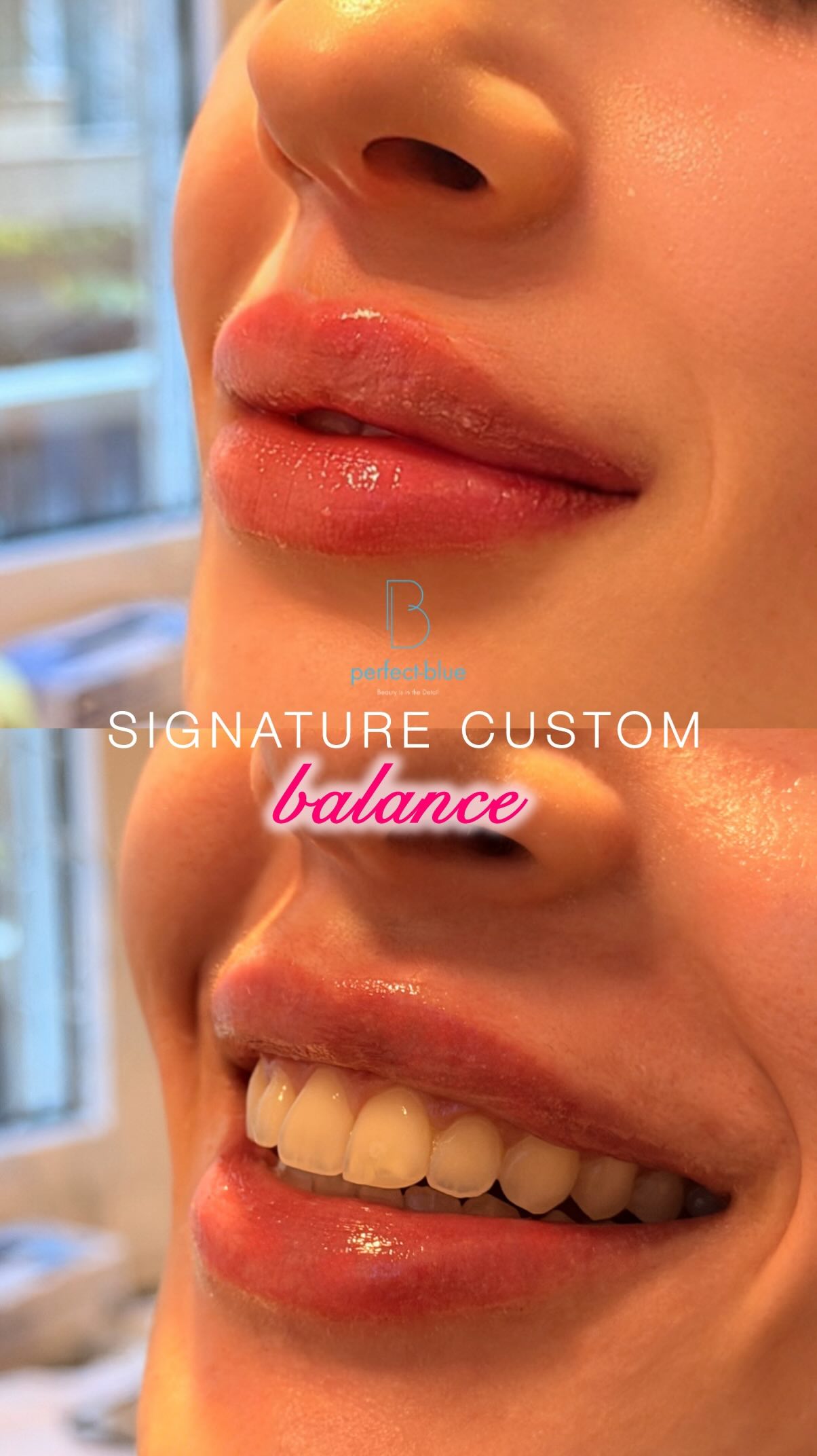 Signature Custom Balance
✨harmony - symmetry - structure✨
Exclusively by @dr.ektor
🖋 A signature result, in just one session.
📍 Athens | Limassol | Nicosia
GR ☎ 210 7258982
CY ☎ 96 444870
📧 info@perfect-blue.com
🌐 www.dr-ektor.com
📲 DM us to schedule your consultation
⭐Only @drektor
#drektor #kolonaki #athens #cyprus #lipfillers