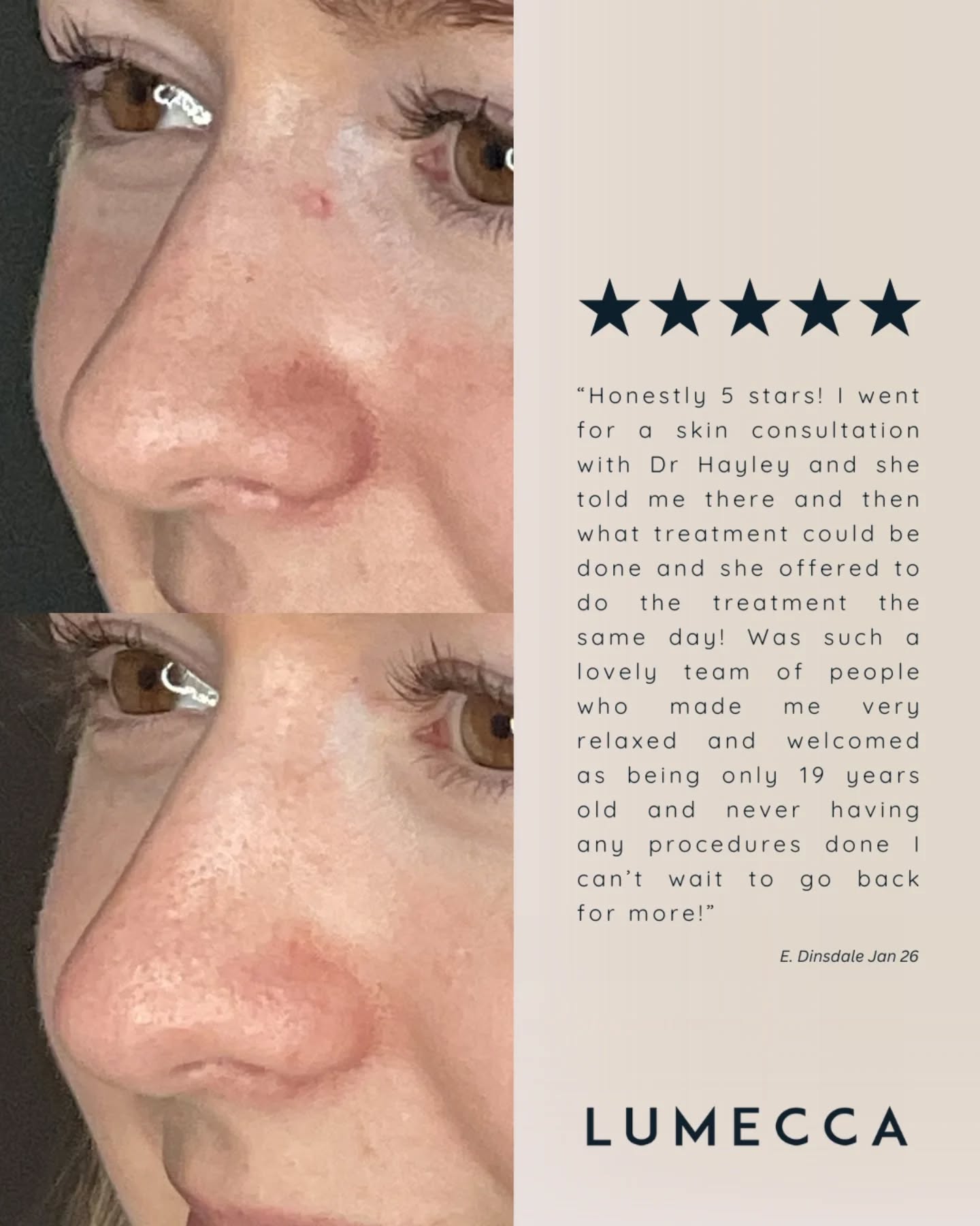 No more heavy concealer needed ✨
That tiny red mark on the side of the nose is a Spider Naevus (dilated capillaries). It’s small, but we know how much it can stand out to you in the mirror.
Lumecca targets the vessel and clears the skin in just a few quick pulses.
Sometimes it's the smallest changes that make a big impact on our confidence.
Got an imperfection that is bothering you? Book your free consultation today to see if we can help!
#lumecca #skinclear #beforeandafter #feelgood #skinclinic