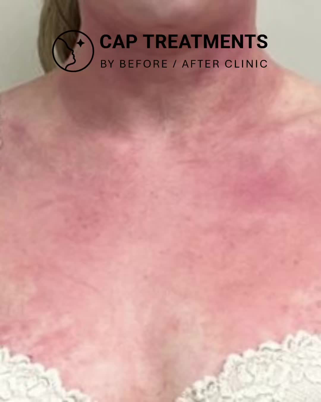 En riktig klinik. En riktig behandling.
Hos CAP Treatments arbetar vi med Cold Atmospheric Plasma – en modern hudbehandling som används för att lugna och stödja huden vid rodnad, irritation och känslighet.
Behandlingen utförs i en professionell klinikmiljö med fokus på trygghet och individuell bedömning.
Du hittar oss i Malmö och Kista.