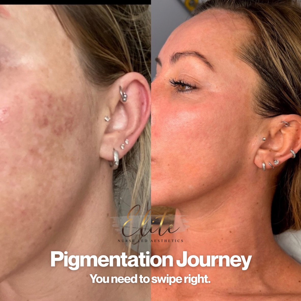 ✨ Pigmentation Journey: Nurse-Led. Bespoke. Results-Driven. ✨
Post-pregnancy hormonal changes can trigger stubborn pigmentation and melanin flare-ups that won’t respond to skincare alone. This is a common but complex condition — and it requires a medical, prescriber-led approach, not generic treatments.
👩⚕️ Nurse Prescriber–Led Assessment
Every plan begins with a detailed skin and medical consultation. As nurse prescribers, we assess hormonal triggers, skin behaviour, and risk factors to create a fully bespoke treatment pathway — safely and effectively.
💡 Your personalised treatment plan included:
🧪 Prescription-Grade Melanin Inhibitors
Target excess pigment production at the source, calm overactive melanocytes, and reduce the risk of rebound pigmentation.
🔥 CO₂ Laser
Treats deeper pigment, resurfaces the skin, stimulates collagen, and improves tone and texture at multiple skin levels.
💧 Hydrafacials
Support barrier repair, enhance hydration, and optimise skin health between laser sessions
#EliteNurseLedAesthetics
#WakefieldAesthetics
#WakefieldSkinClinic
#WakefieldBeautyClinic
#AestheticsWakefield