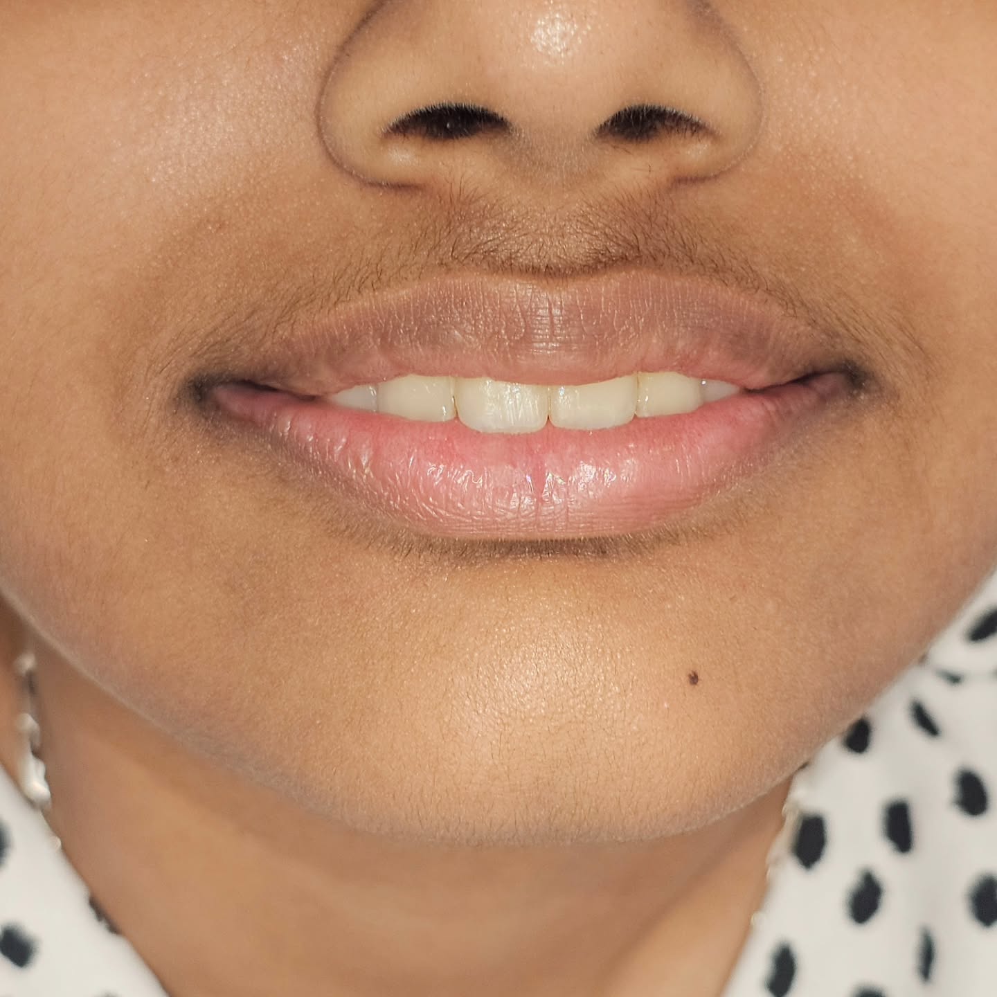 Braces off after orthodontic treatment completion in 9 months .
Precise, Pleasant and Aesthetic Dentistry