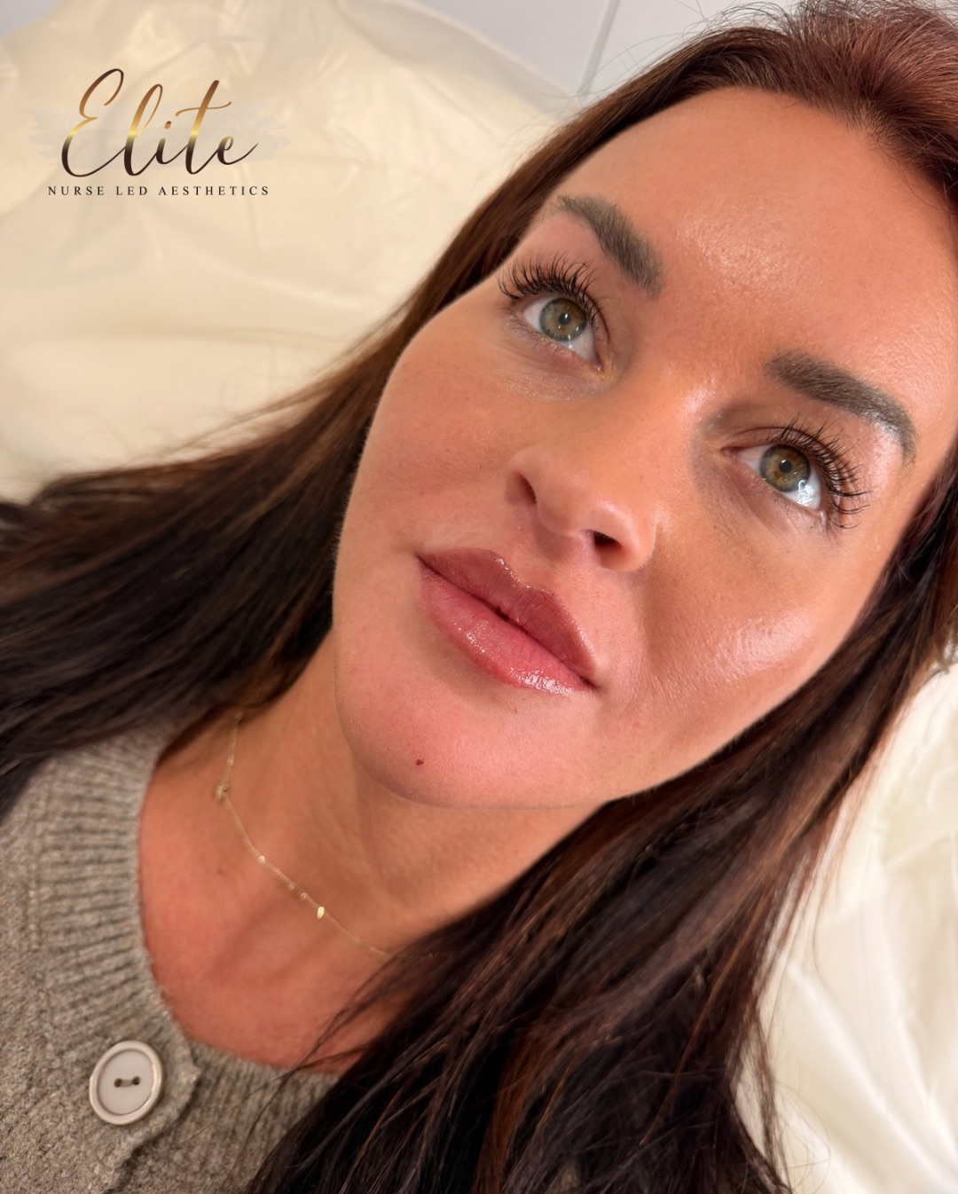 Enhance what you already have — naturally
Lip enhancement doesn’t have to mean overfilled. Sometimes the most beautiful results come from subtle refinement.
Our approach focuses on enhancing your natural lip shape, improving balance and definition while keeping your lips soft, natural, and perfectly suited to your face.
✨ What natural lip enhancement can do:
✔ Enhance your natural lip shape
✔ Add subtle volume and definition
✔ Improve symmetry and balance
✔ Hydrate and smooth the lips
✔ Create a soft, natural-looking result
The goal? Lips that look like yours — just better.
📍 Elite Nurse Led Aesthetics – Wakefield
💬 Ready for naturally beautiful lips?
Book your consultation today and let’s enhance your natural beauty 💉✨
#EliteNurseLedAesthetics
#WakefieldLips
#NaturalLipEnhancement
#WakefieldAesthetics
#LipFillerWakefield