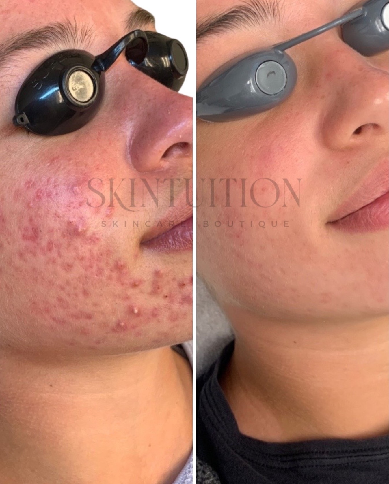 Clear skin is a marathon, not a sprint but you don’t have to run it alone. 🏃♀️💨 Our Acne Bootcamp is designed to give you access to a comprehensive range of resources specifically curated for your skin’s needs. We leave no stone unturned and utilize everything in our power to help you feel confident in your own skin again. Check out this incredible transformation!
#louisvilleesthetician #louisvilleskincare #louisvillefacial