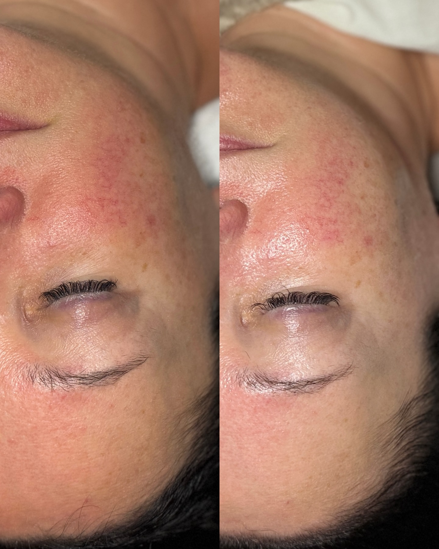 Swipe to see what happens when you calm inflammation and nourish the skin at a cellular level ➡️✨
Our Vital Antioxidant Facial is a powerful treatment designed to restore balance and bring the skin back to its healthiest state.
This facial features a potent blend of vitamin C, firming peptides, hyaluronic acid, and antioxidant-rich ingredients that work to strengthen the skin, improve tone, and reveal a brighter, smoother complexion.
Enhanced with a Hydrojelly®️ mask and relaxing elements like a scalp, hand, and arm massage, this treatment delivers visible results AND deep relaxation- Ahhhhh🧘♀️.
Healthy skin starts when inflammation is brought back into balance. ✨
🎥✍🏼🫶🏻 @esthetician.brittany