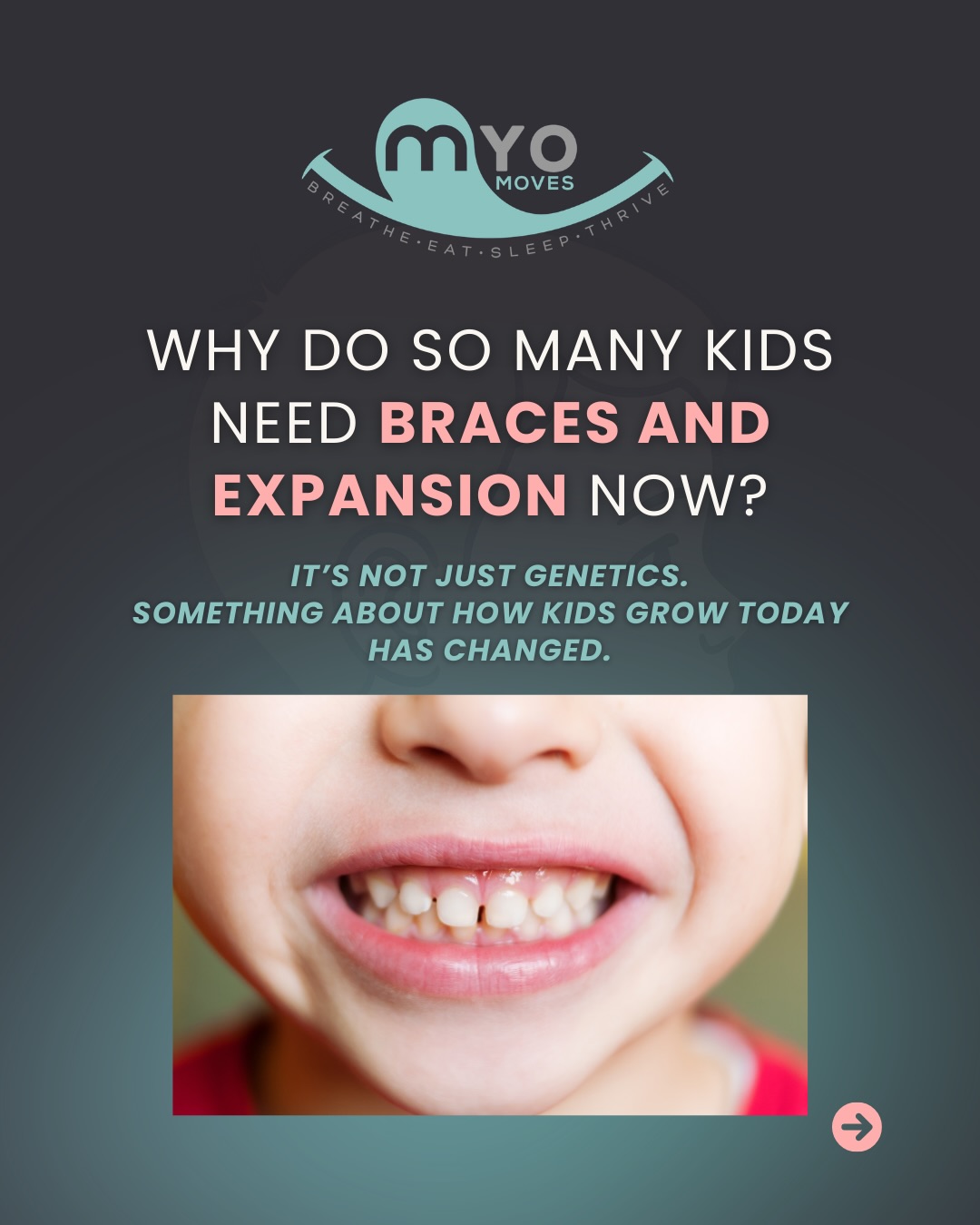 Why do so many kids need braces or expansion today?
It’s not that genetics suddenly changed. It’s that the environment around development has changed. Breathing patterns, tongue posture, chewing habits, and oral rest posture all influence how the jaws grow.
When the upper jaw doesn’t develop wide enough, teeth simply don’t have the space they need.
Orthodontics can create alignment and space — but understanding development helps explain why crowding happens in the first place.
Comment MYO if you’re ready to learn how myofunctional therapy can support YOUR airway and jaw development!
#myofunctionaltherapy #airwayhealth #mouthbreathing #expansion #myo