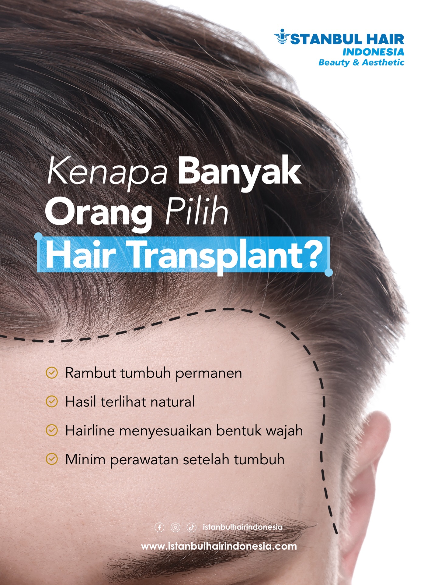 Rambut yang kembali tumbuh bukan sekadar soal penampilan, tetapi juga tentang rasa percaya diri. ✨
Dengan teknik modern, hair transplant menghadirkan hasil yang tampak alami, hairline yang dirancang menyesuaikan karakter wajah, serta pertumbuhan rambut permanen dengan perawatan yang minimal setelahnya.
Saatnya tampil lebih percaya diri dengan solusi yang tepat.
📍 Istanbul Hair Indonesia
💬 Konsultasi GRATIS sekarang
📲 Klik link di bio atau DM kami untuk penjadwalan
#HairTransplantIndonesia #IstanbulHairIndonesia #HairTransplantJakarta #SolusiRambutRontok #HairlineNatural