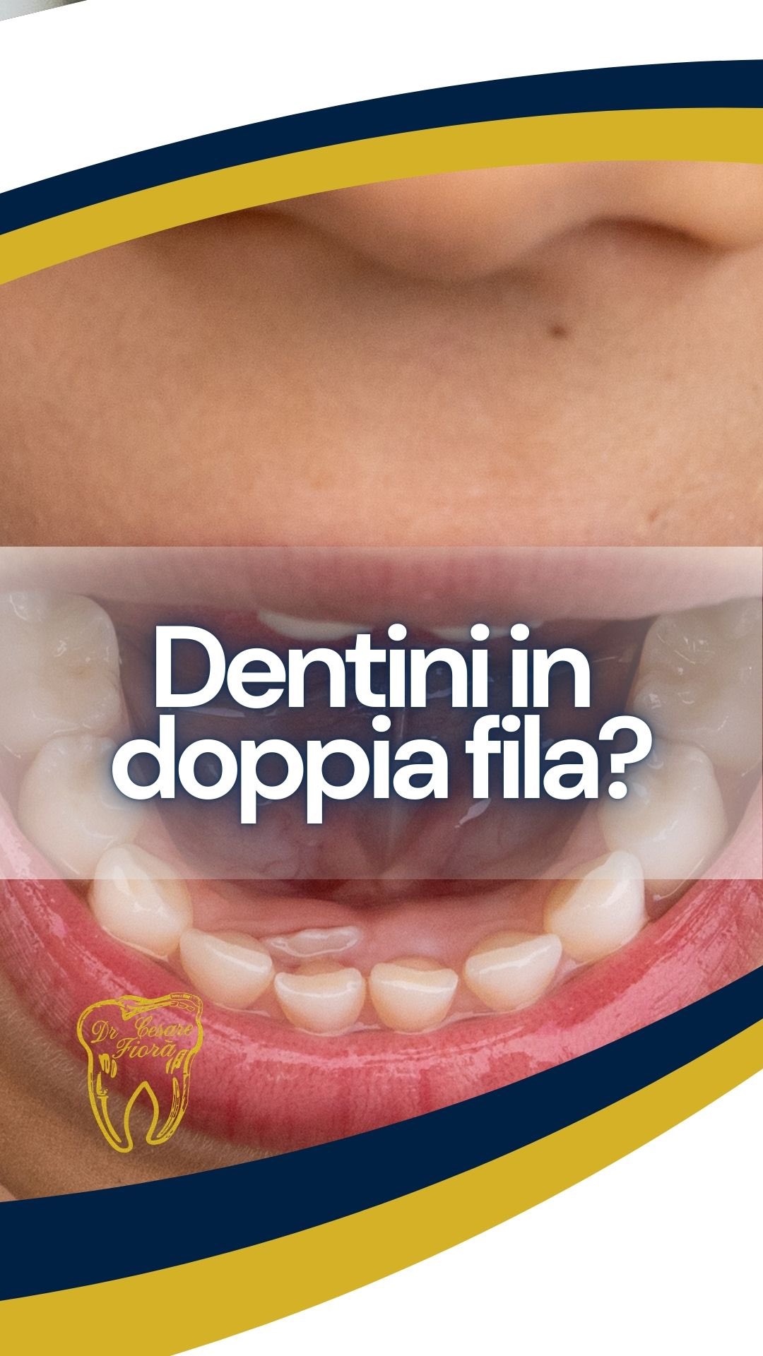 𝐃𝐞𝐧𝐭𝐢𝐧𝐢 𝐢𝐧 𝐝𝐨𝐩𝐩𝐢𝐚 𝐟𝐢𝐥𝐚? 𝐍𝐢𝐞𝐧𝐭𝐞 𝐩𝐚𝐧𝐢𝐜𝐨.
𝖤̀ 𝗆𝗈𝗅𝗍𝗈 𝗉𝗂𝗎̀ 𝖼𝗈𝗆𝗎𝗇𝖾 𝖽𝗂 𝗊𝗎𝖺𝗇𝗍𝗈 𝗉𝖾𝗇𝗌𝗂.
𝖰𝗎𝖺𝗇𝖽𝗈 𝗂𝗅 𝖽𝖾𝗇𝗍𝖾 𝖽𝖾𝖿𝗂𝗇𝗂𝗍𝗂𝗏𝗈 𝗌𝗉𝗎𝗇𝗍𝖺 𝖽𝗂𝖾𝗍𝗋𝗈 𝖺 𝗊𝗎𝖾𝗅𝗅𝗈 𝖽𝖺 𝗅𝖺𝗍𝗍𝖾, 𝗉𝗎𝗈̀ 𝗌𝖾𝗆𝖻𝗋𝖺𝗋𝖾 𝖼𝗁𝖾 𝗂 𝖽𝖾𝗇𝗍𝗂 𝗌𝗂𝖺𝗇𝗈 “𝗂𝗇 𝖽𝗈𝗉𝗉𝗂𝖺 𝖿𝗂𝗅𝖺”.
𝖨𝗇 𝗋𝖾𝖺𝗅𝗍𝖺̀ 𝐞̀ 𝐮𝐧𝐚 𝐬𝐢𝐭𝐮𝐚𝐳𝐢𝐨𝐧𝐞 𝐦𝐨𝐥𝐭𝐨 𝐟𝐫𝐞𝐪𝐮𝐞𝐧𝐭𝐞 𝐧𝐞𝐢 𝐛𝐚𝐦𝐛𝐢𝐧𝐢.
☞︎ 𝖭𝖾𝗅𝗅𝖺 𝗆𝖺𝗀𝗀𝗂𝗈𝗋 𝗉𝖺𝗋𝗍𝖾 𝖽𝖾𝗂 𝖼𝖺𝗌𝗂 𝗇𝗈𝗇 𝖼’𝖾̀ 𝖽𝖺 𝗉𝗋𝖾𝗈𝖼𝖼𝗎𝗉𝖺𝗋𝗌𝗂: 𝖻𝖺𝗌𝗍𝖺 𝖽𝖺𝗋𝖾 𝗎𝗇 𝗉𝗈’ 𝖽𝗂 𝗍𝖾𝗆𝗉𝗈 𝖺𝗅 𝖽𝖾𝗇𝗍𝗂𝗇𝗈 𝖽𝖺 𝗅𝖺𝗍𝗍𝖾 𝖽𝗂 𝗆𝗎𝗈𝗏𝖾𝗋𝗌𝗂 𝗌𝖾𝗆𝗉𝗋𝖾 𝖽𝗂 𝗉𝗂𝗎̀ 𝖿𝗂𝗇𝗈 𝖺 𝖼𝖺𝖽𝖾𝗋𝖾 𝗇𝖺𝗍𝗎𝗋𝖺𝗅𝗆𝖾𝗇𝗍𝖾.
✔︎ 𝖲𝖾 𝗂𝗇𝗏𝖾𝖼𝖾 𝗂𝗅 𝖽𝖾𝗇𝗍𝗂𝗇𝗈 𝖽𝖺 𝗅𝖺𝗍𝗍𝖾 𝗇𝗈𝗇 𝖼𝖺𝖽𝖾 𝖽𝖺 𝗌𝗈𝗅𝗈, 𝗌𝖺𝗋𝖺̀ 𝗂𝗅 𝖽𝖾𝗇𝗍𝗂𝗌𝗍𝖺 𝖺𝖽 𝖺𝗂𝗎𝗍𝖺𝗋𝖾 𝖼𝗈𝗇 𝗎𝗇𝖺 𝗌𝖾𝗆𝗉𝗅𝗂𝖼𝖾 𝗋𝗂𝗆𝗈𝗓𝗂𝗈𝗇𝖾.
✨ 𝖤 𝗉𝗈𝗂 𝗌𝗎𝖼𝖼𝖾𝖽𝖾 𝗊𝗎𝖺𝗅𝖼𝗈𝗌𝖺 𝖽𝗂 𝗌𝗈𝗋𝗉𝗋𝖾𝗇𝖽𝖾𝗇𝗍𝖾: 𝗅𝖺 𝗅𝗂𝗇𝗀𝗎𝖺, 𝖼𝗈𝗇 𝗂𝗅 𝗍𝖾𝗆𝗉𝗈, 𝖺𝗂𝗎𝗍𝖺 𝗂𝗅 𝖽𝖾𝗇𝗍𝖾 𝖽𝖾𝖿𝗂𝗇𝗂𝗍𝗂𝗏𝗈 𝖺 𝗍𝗋𝗈𝗏𝖺𝗋𝖾 𝗂𝗅 𝗌𝗎𝗈 𝗉𝗈𝗌𝗍𝗈 𝗇𝖺𝗍𝗎𝗋𝖺𝗅𝖾.
𝐏𝐫𝐨𝐩𝐫𝐢𝐨 𝐩𝐞𝐫 𝐪𝐮𝐞𝐬𝐭𝐨 𝐞̀ 𝐢𝐦𝐩𝐨𝐫𝐭𝐚𝐧𝐭𝐞 𝐯𝐚𝐥𝐮𝐭𝐚𝐫𝐞 𝐥𝐚 𝐬𝐢𝐭𝐮𝐚𝐳𝐢𝐨𝐧𝐞 𝐜𝐨𝐧 𝐜𝐚𝐥𝐦𝐚 𝐞 𝐜𝐨𝐧 𝐢 𝐭𝐞𝐦𝐩𝐢 𝐠𝐢𝐮𝐬𝐭𝐢.
👩⚕️ 𝖲𝖾 𝗁𝖺𝗂 𝗇𝗈𝗍𝖺𝗍𝗈 𝖽𝖾𝗇𝗍𝗂 𝗂𝗇 𝖽𝗈𝗉𝗉𝗂𝖺 𝖿𝗂𝗅𝖺 𝗇𝖾𝗅 𝗌𝗈𝗋𝗋𝗂𝗌𝗈 𝖽𝖾𝗅 𝗍𝗎𝗈 𝖻𝖺𝗆𝖻𝗂𝗇𝗈, 𝗏𝗂𝖾𝗇𝗂 𝖺 𝖿𝖺𝗋𝗅𝗂 𝖼𝗈𝗇𝗍𝗋𝗈𝗅𝗅𝖺𝗋𝖾: 𝖼𝖺𝗉𝗂𝗋𝖾𝗆𝗈 𝗂𝗇𝗌𝗂𝖾𝗆𝖾 𝗌𝖾 𝖾̀ 𝗌𝗈𝗅𝗈 𝗊𝗎𝖾𝗌𝗍𝗂𝗈𝗇𝖾 𝖽𝗂 𝗍𝖾𝗆𝗉𝗈.
📩 𝖲𝖼𝗋𝗂𝗏𝗂𝖼𝗂 𝗈 𝗉𝗋𝖾𝗇𝗈𝗍𝖺 𝗎𝗇𝖺 𝗏𝗂𝗌𝗂𝗍𝖺.
𝖲𝗍𝗎𝖽𝗂𝗈 𝖽𝖾𝗇𝗍𝗂𝗌𝗍𝗂𝖼𝗈 𝖥𝗂𝗈𝗋𝖺̀
📍𝖦𝗂𝗎𝗅𝗂𝖺𝗇𝗈𝗏𝖺,𝗏𝗂𝖺 𝖡𝗈𝗌𝖼𝗈 𝖬𝖺𝗋𝗍𝖾𝗌𝖾 𝟥𝟢
📞 0𝟪𝟧.𝟪𝟢𝟢𝟦𝟥𝟥𝟣
𝐃.𝐒. 𝖢𝖾𝗌𝖺𝗋𝖾 𝖥𝗂𝗈𝗋𝖺̀, 𝖠𝗅𝖻𝗈 𝗈𝖽𝗈𝗇𝗍𝗈𝗂𝖺𝗍𝗋𝗂 𝖽𝗂 𝖳𝖾𝗋𝖺𝗆𝗈 𝗇.𝟥𝟧𝟥
#dentistabimbi #dentibimbi #sorrisogiulianova #gbtigieneorale #studiodentisticogiulianova