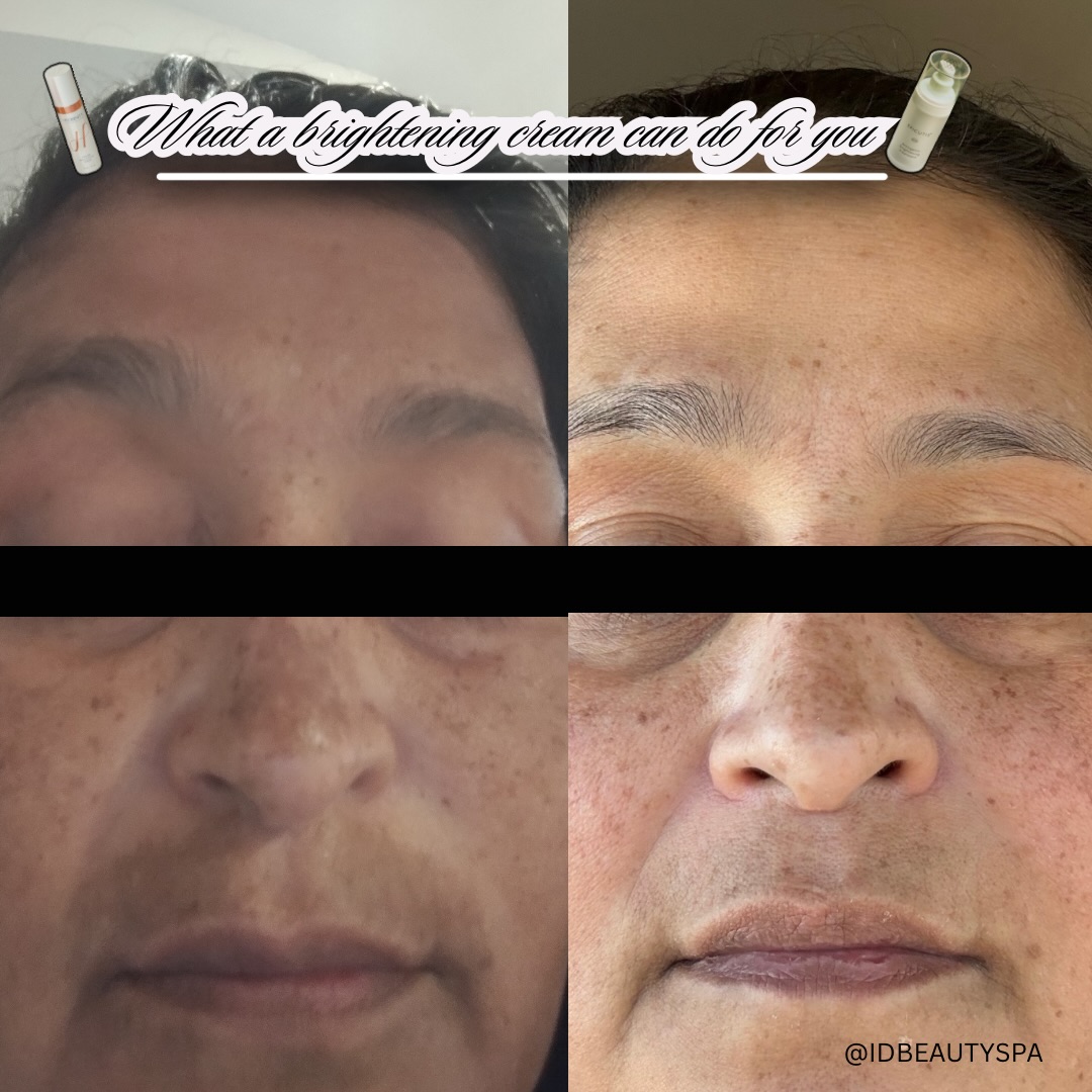 CLIENT UPDATE ‼️
The real before & after. My client reached out to me and said I needed to put the true B&A because the last photos weren’t accurate. I guess the photos she sent wasn’t when she initially started or where her skin is at now!
And the results?? Even better 💋
One bottle of Vivid Brightening ➡️ Pause in treatment from derm’s prescription that DESTROYED her barrier ➡️ Arctigening Brightening Treatment 🟰MAJOR PIGMENT REDUCTION
Wanting to reverse sun damage, melasma, and acne scarring? Book a consultation with your Utah Esthetician @ idbeautyspa.com 💫