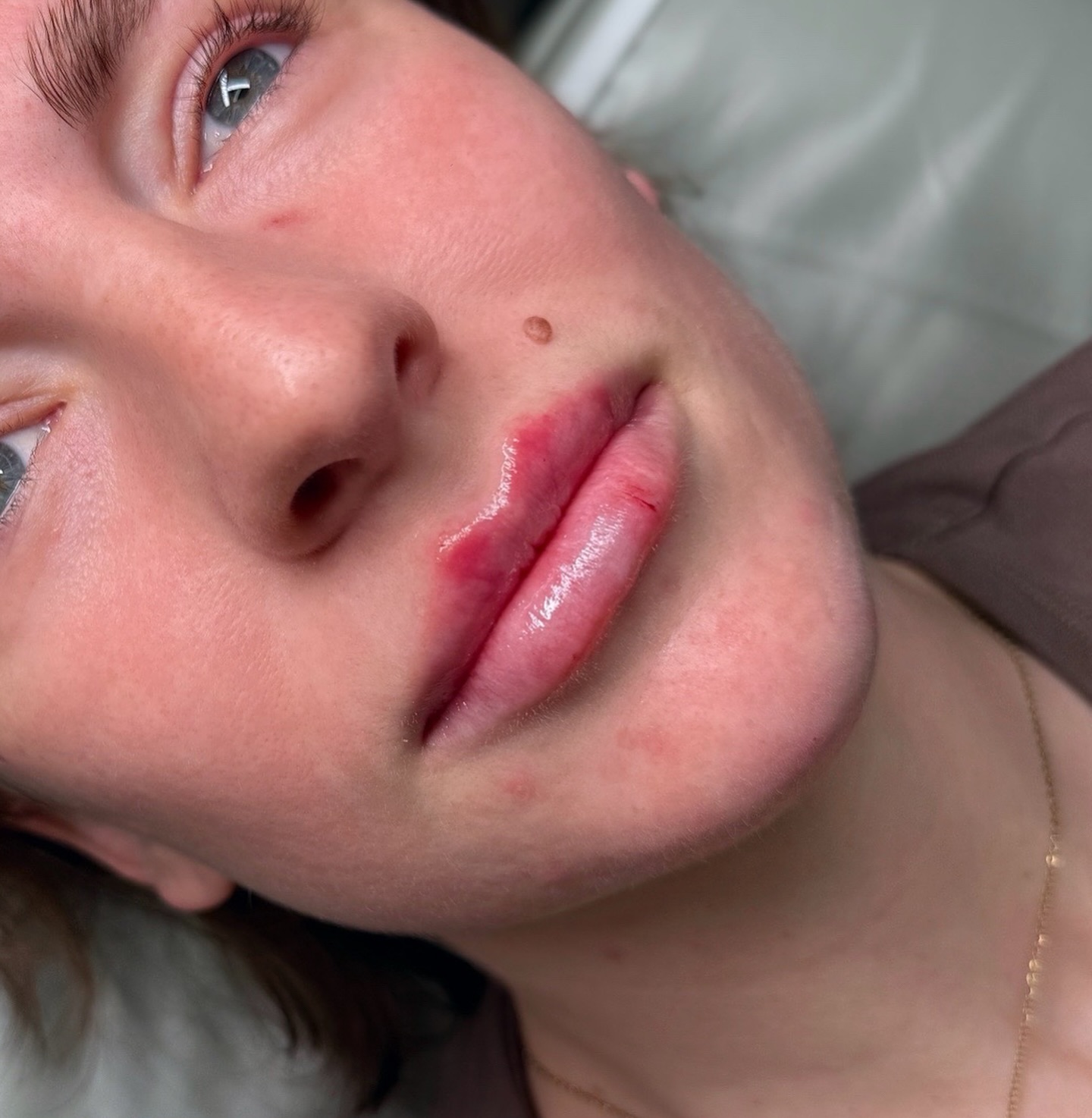 POV: You asked for natural but noticeable lips 💋
Soft volume
Hydrated finish
Perfectly balanced shape
Fresh results immediately after treatment - swelling & bruising will settle and the lips will soften beautifully.
We also tweaked the chin by adding 0.3ml to balance the side profile slightly 👌🏼swipe to see the results
Next lip appointment in Barnham is 10th April