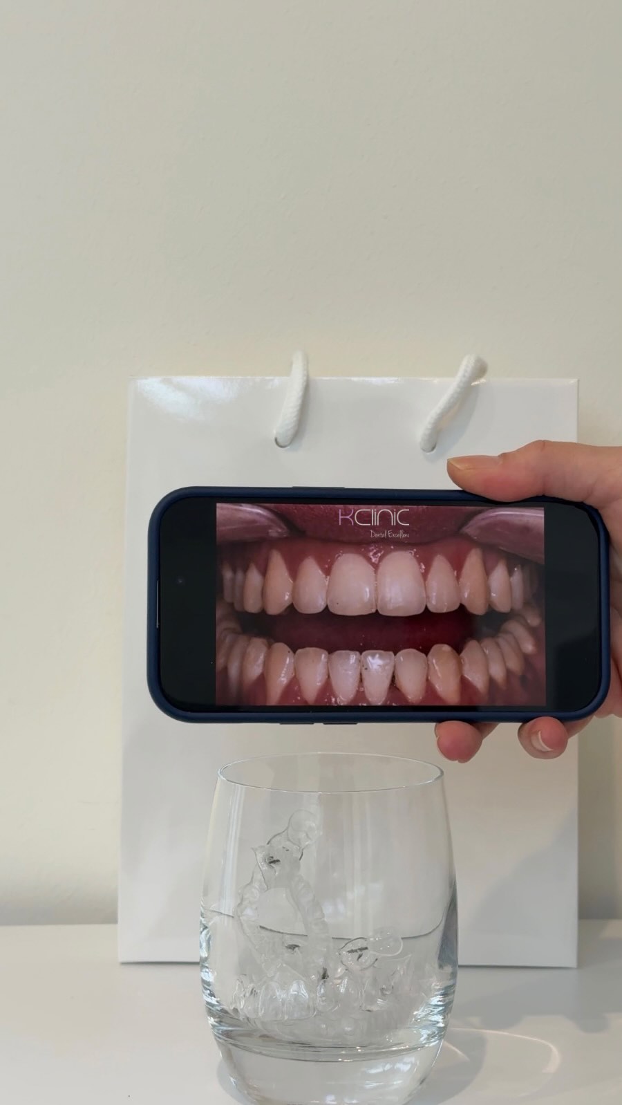 🦷 Thinking about straightening your teeth without metal braces?
Meet Angel Aligner – modern, clear aligners that transform your smile discreetly and comfortably 😍
✨ Benefits of Angel Aligner:
1️⃣ Nearly invisible – perfect for anyone who values aesthetics.
2️⃣ Comfortable to wear – no wires or gum irritation.
3️⃣ Removable for eating and brushing, making daily hygiene much easier.
⚠️ A few things to keep in mind:
1️⃣ They require discipline – you should wear them about 22 hours a day.
2️⃣ Not every case can be treated with aligners (sometimes fixed braces are needed).
3️⃣ You’ll need to change your aligners regularly and attend check-up visits.
💬 The best way to find out if Angel Aligner is right for you is to come for a FREE orthodontic consultation at our clinic!😍
0 % Finance options available
📍7 Windsor Way, Knutsford WA16 6JB
🌐 www.kclinic.co.uk
📱 07946 219 539
☎️ 01565 653480
#AngelAligners #SmileTransformation #BeforeAndAfter #StraightSmile #Orthodontics