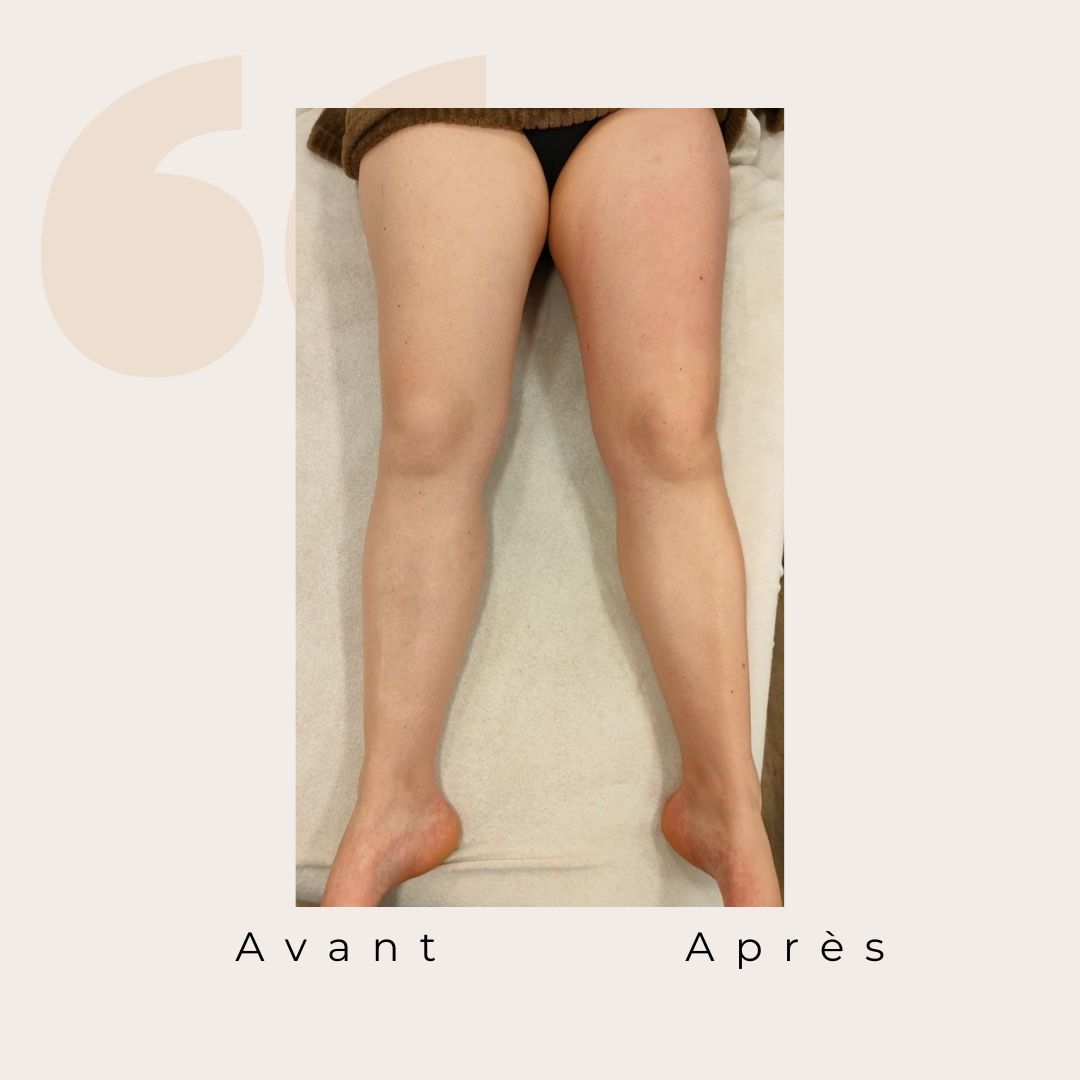 ✨ Avant / Après – Drainage lymphatique Renata França ✨
Dès la première séance, le corps réagit.
Des jambes visiblement plus légères, un galbe redessiné et une sensation immédiate de bien-être 🌿
Le drainage lymphatique Renata França agit en profondeur pour :
✨ stimuler la circulation lymphatique
✨ réduire la rétention d’eau
✨ affiner et détoxifier les jambes
✨ apporter une sensation de légèreté durable
Résultat visible, ressenti immédiat 🤍
Chaque corps est unique, les résultats peuvent varier, mais la légèreté, elle, est toujours au rendez-vous ✨
#drainagelymphatique #renatafranca #avantapres #jambeslegeres #retentiondeau #bienetre #soincorps #detox #momentpoursoi