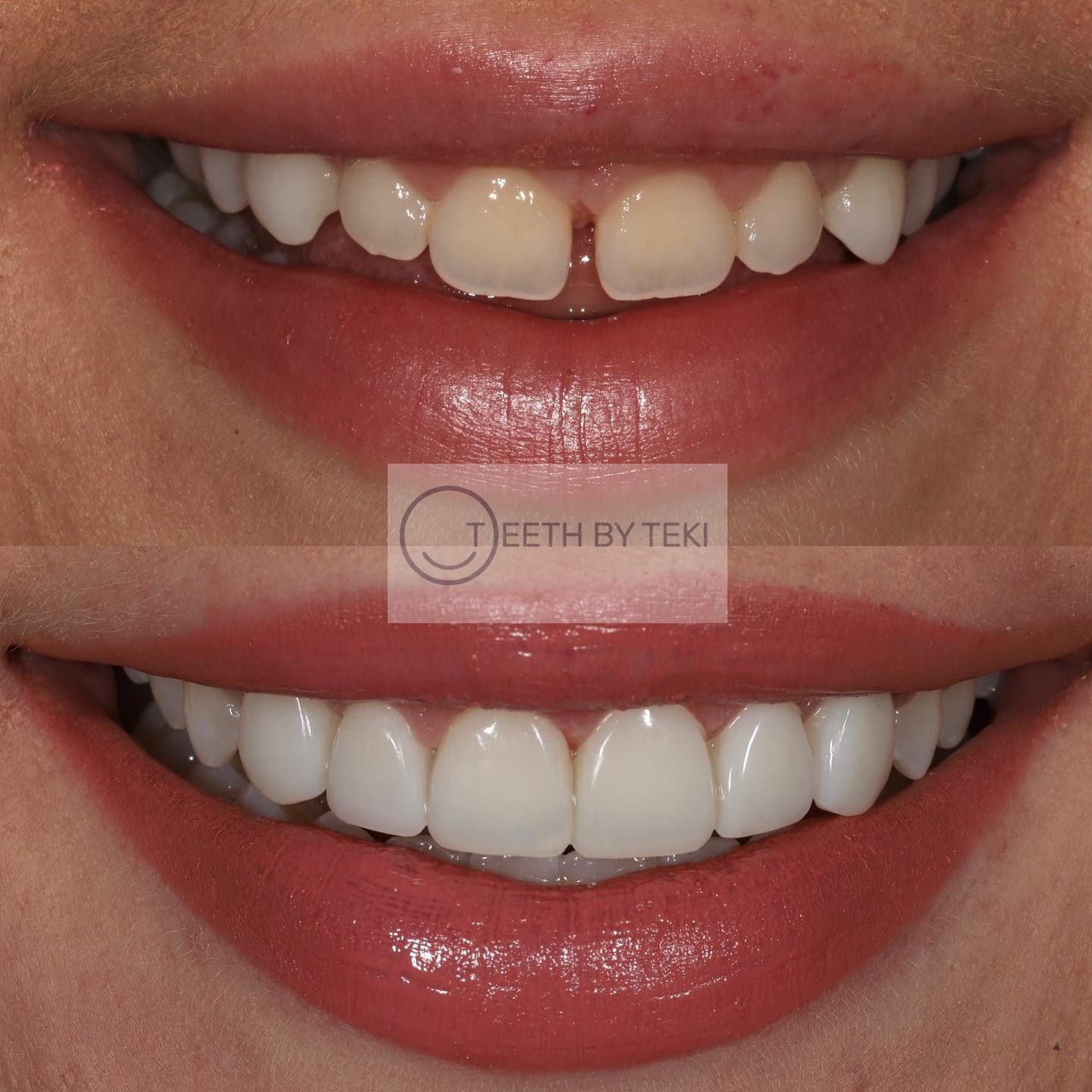 Life changing ⚪️💙
.
.
Invisalign, whitening, gum contouring and composite bonding
(Gum contouring done by Dr Mohsen at Dream Smile)
.
.
#teethbyteki #lifechanging