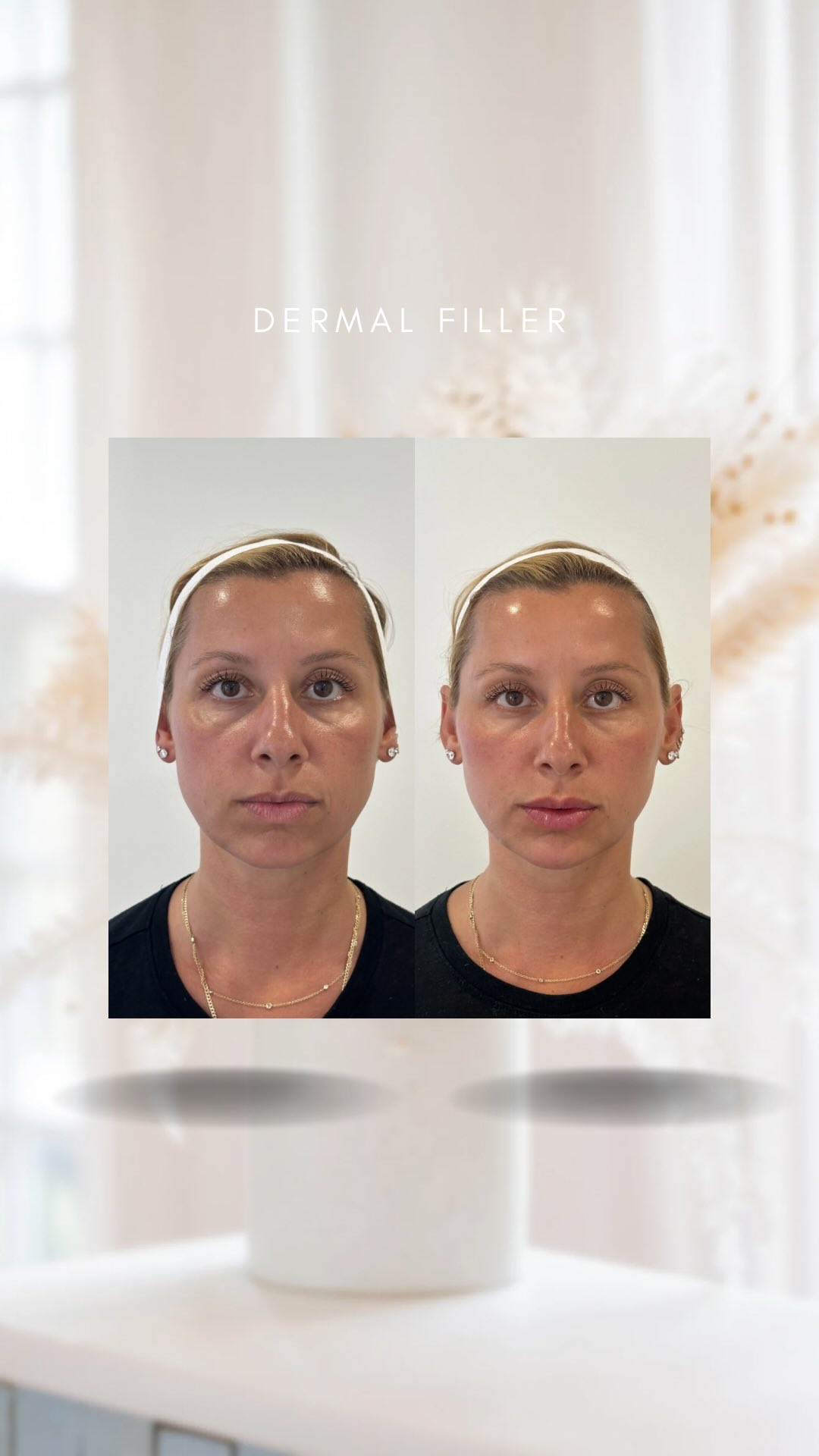 When facial balancing with dermal filler is done well, something looks different, but it is hard to immediately pinpoint what has changed📌
Even with swelling present immediately after treatment, you might notice a more refreshed under-eye area, less heaviness in the lower face, improved cheek support, and subtle lip enhancement that creates a softer, more balanced facial shape.
The goal is not to change, but to bring balance and structure back to the face ✨
#nantucketma #dermalfiller #juvederm #allerganmedicalinstitute #beforeandafter