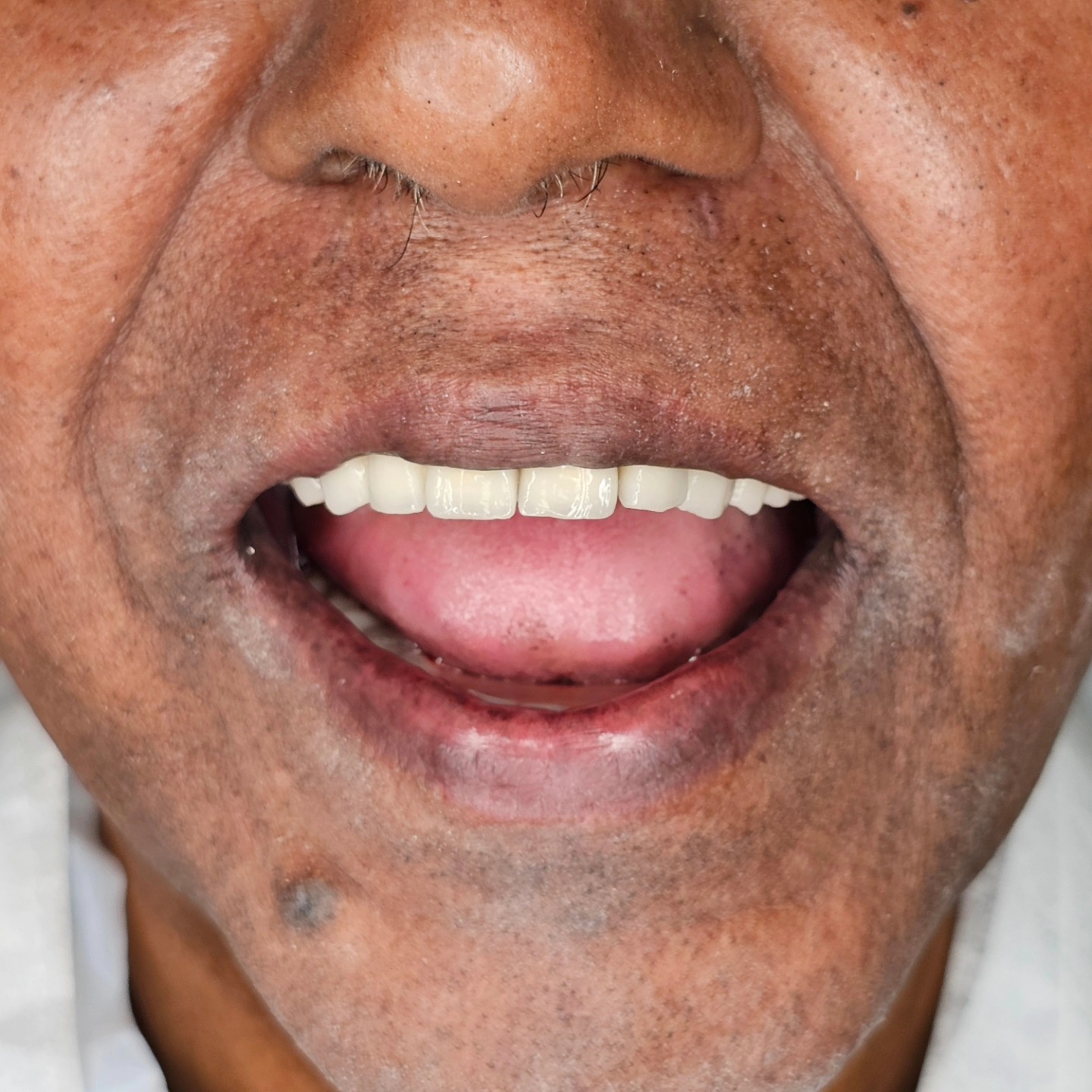 Smile is the beauty of the soul. Can you disagree after seeing this innocent smile?
The greatest award we get for our work at Sethu's Dental House is literally this. The final happy smile of our patients.
Happy to have been of aid to this wonderful gentlemen who wanted to eat the food he desired without any difficulty.
The old improper restorations have been completely changed to provide a more proper full mouth rehabilitation
Upper full arch fixed partial dentures (with multiple segments) and lower implant supported bar and ball overdenture .
Sethu's Dental House
Precise, Pleasant and Aesthetic Dentistry
#dentistry #fullmouthrehabilitation #fullmouthreconstruction #dentistlife #dentalphotography #implantology #overdenture #implant #smile #smilemakeover #sethusdentalhouse