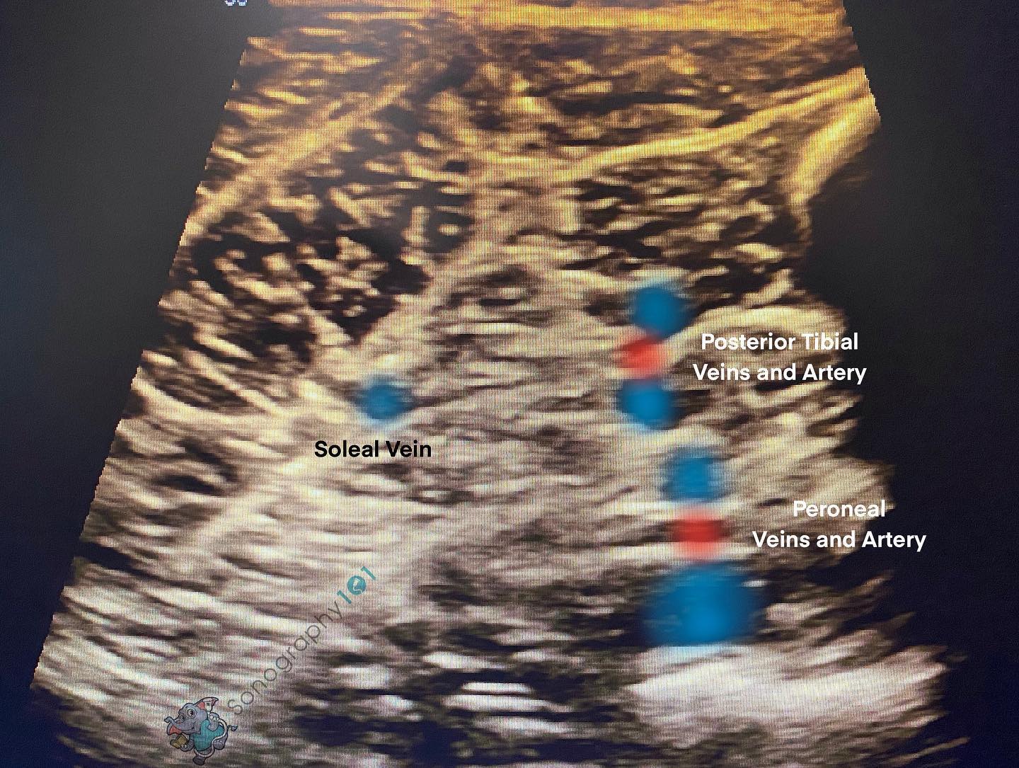 Normal soleal vein vs. thrombosis of the soleal vein.
Why is it critical to know?
It is extremelyyy common for patients to have a thrombus in this vessel. A lot of the times when they have isolated calf pain and the PTVs/Peroneals aren’t affected, it is actually because of the soleal vein or the gastrocnemius veins. Yes, in some patients these vessels are difficult to visualize but that’s not always the case. So give it a shot 😁 practice on those easy patients that way you are 100% sure when they’re abnormal. 🤗
Happy scanning 🤓
