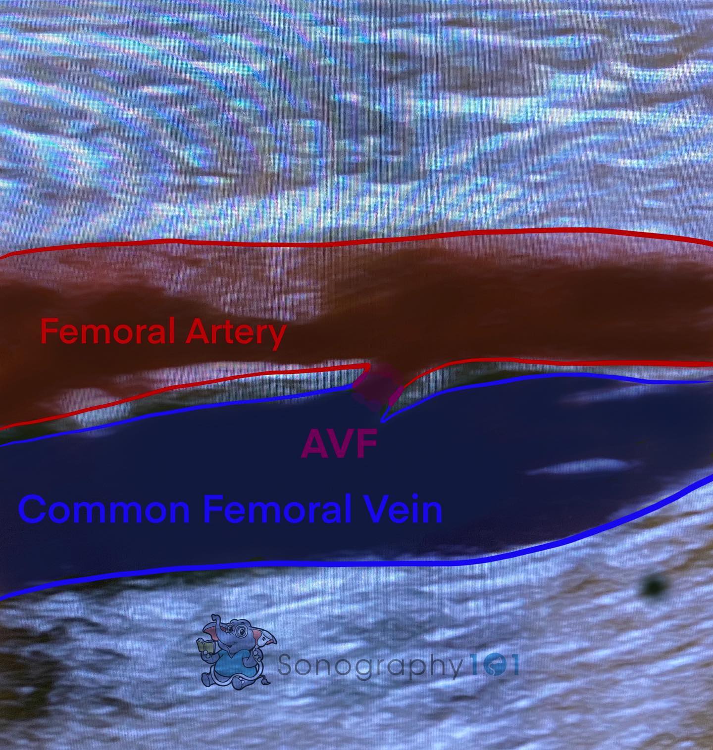 As sonographers we deal a lot with arteriovenous fístulas and grafts that are created for dialysis. In occasion we also come across these bad boys: iatrogenic AVFs. Unlike hemodialysis access fístulas/grafts, these weren’t meant to be created. “Iatrogenic arteriovenous fístulas (AVFs) are rare. Femoral AVFs can result from penetrating injuries as well as more frequently from percutaneous vascular interventions. The incidence of post-catheterization AVFs ranges from 0.006 to 0.86% whilst that of all vascular complications varies from 1 to 9%.”
.
.
.
.
#ultrasound #sonography #medicalsonography #RDMS #RVT #RegisteredDiagnosticMedicalSonographer #RegisteredVascularTechnologist #UltrasoundTechnologist #Sonographer #UltrasoundTech #Sonography101 #ultrasoundED #ultrasononography #ultrasonographer #Medicine #Medical #Radiology #Radiologia #Ultrasonido #DiagnosticImaging #Medicina #Sonograma
#sonographystudent #sonographyschool