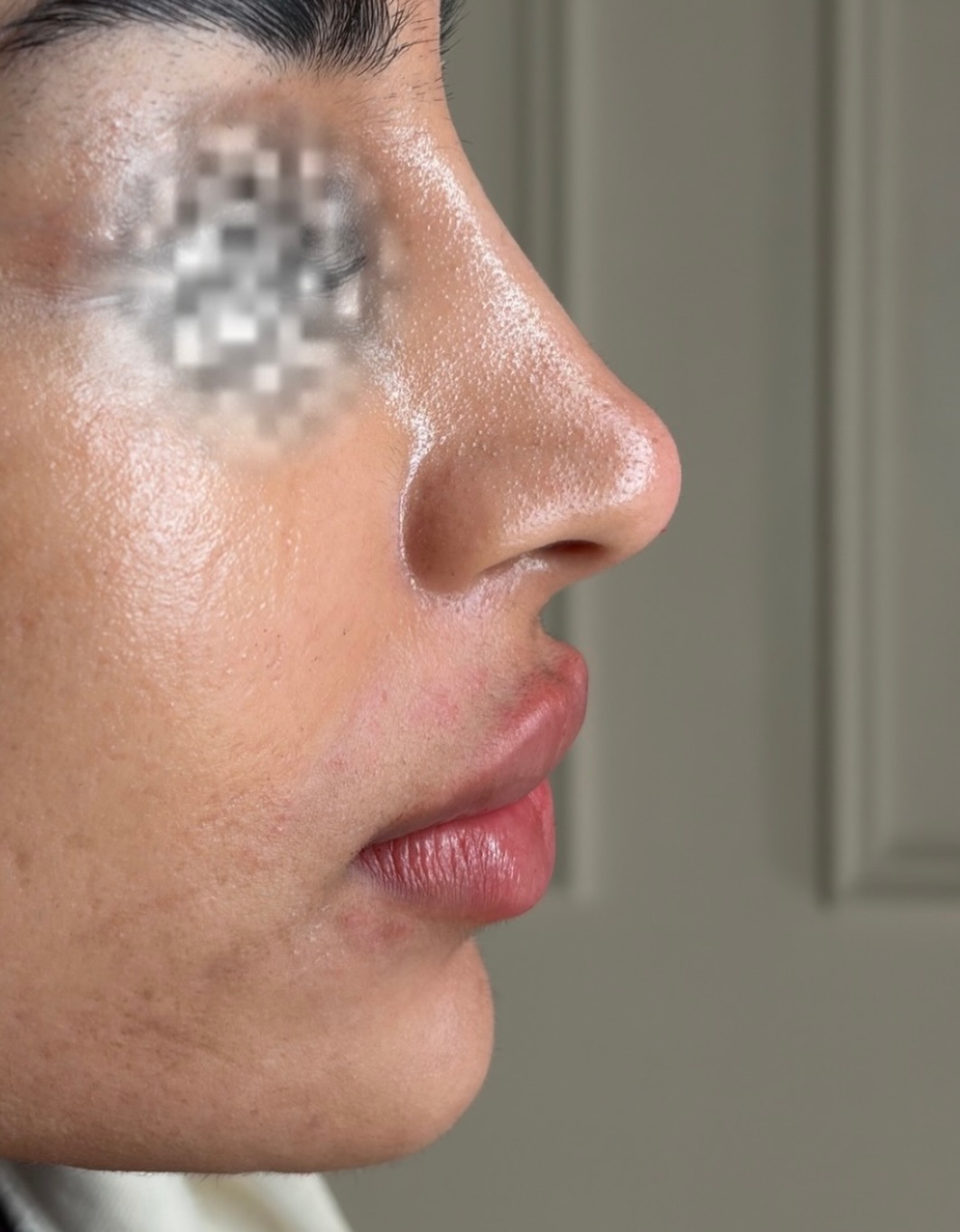 Profile harmony.
Sometimes the biggest difference isn’t one treatment — it’s how multiple areas work together.
In this case we treated the nose, lips and chin to refine the overall facial balance and projection.
• Non-surgical rhinoplasty to smooth and refine the nasal profile
• Tailored lip enhancement to restore shape and structure
• Chin augmentation to improve lower face projection and balance
When these areas are treated strategically, the result is facial harmony rather than obvious filler.
The goal is never to “add volume everywhere.”
It’s to create proportion, structure and balance within the face.
Small adjustments.
Big difference. 🤍