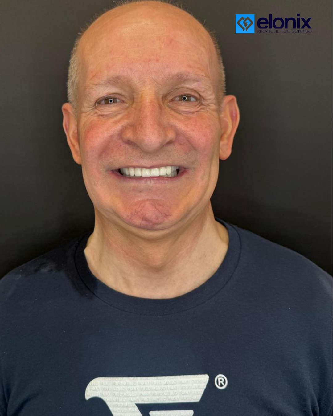 Un altro trattamento completato con successo! Il paziente ha terminato il suo percorso ed è molto soddisfatto del nuovo sorriso. Professionalità, cura dei dettagli e risultati che parlano da soli.😍