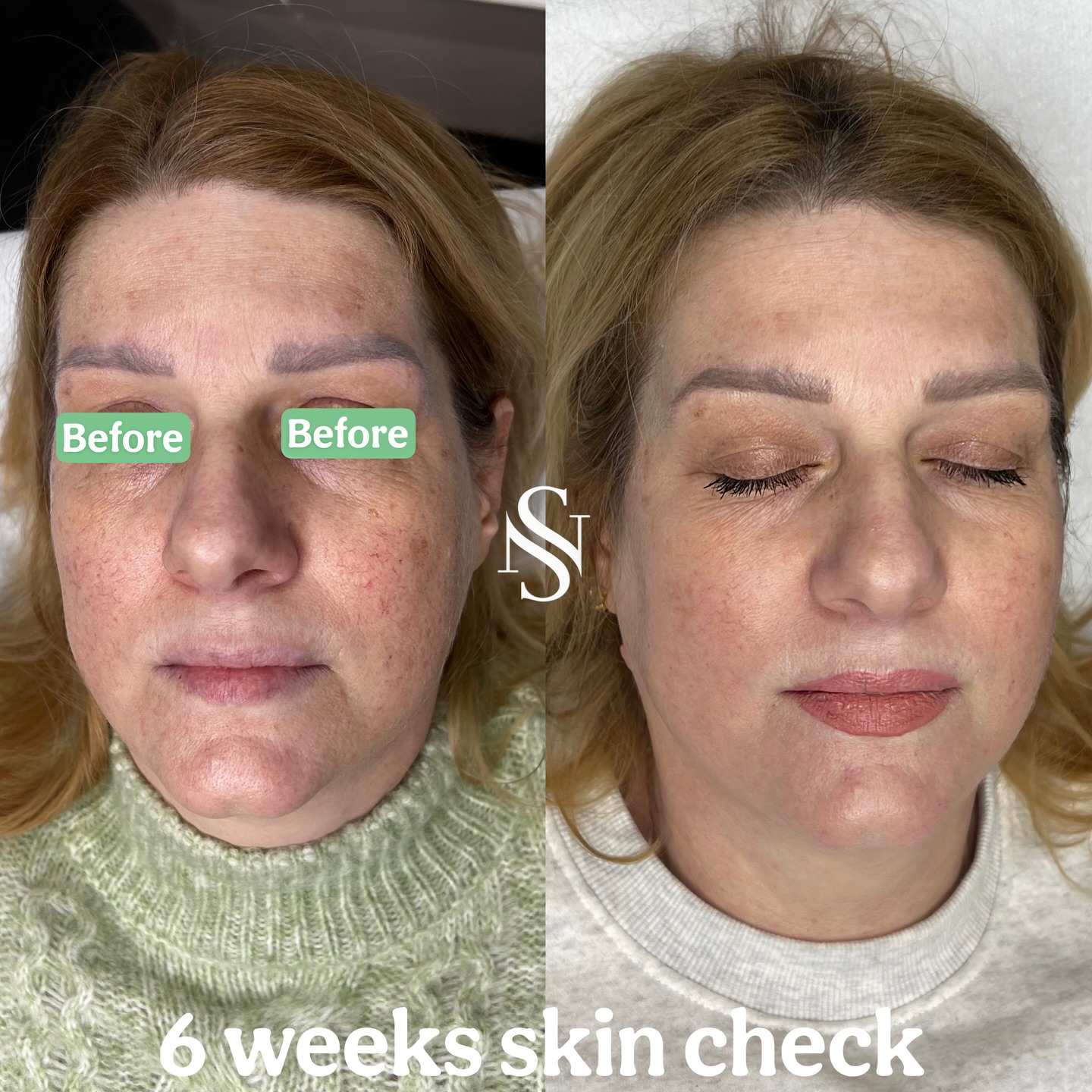 ✨SKIN TRANSFORMATION IN PROGRESS✨
Two months ago this lovely client came to the clinic for a skin consultation.
Her main concerns were pigmentation, dull skin tone, skin laxity, uneven tone, and looking constantly tired.
We started with the Obagi Nu-Derm kit to improve skin quality and address pigmentation at home.
Alongside this, she had 2 sessions of PRX-T33 and 1 session of microneedling with polynucleotides to stimulate skin regeneration and improve texture and brightness.
When she came back for review, the change was visible the moment she walked in😱
Her skin looked brighter, clearer, and more even, and she arrived with no makeup and so enthusiastic about the improvement😍❤️
🗒️The plan is: two more sessions of microneedling with polynucleotides, two more sessions of PRX-T33, and continuing a strict skincare regimen at home.
This is what happens when medical-grade skincare and in-clinic treatments work together👩🏼⚕️✨
@obagimedical @obagiuk @prxt33_uk @vitaran_uk
#skin #skinhealth #pigmentation