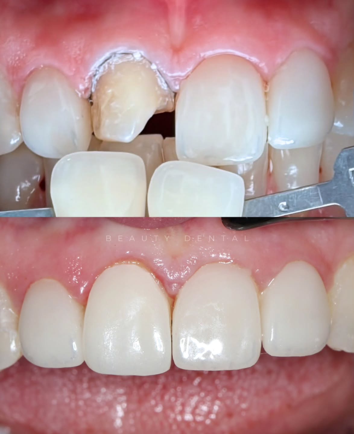 A veces un pequeño detalle puede cambiar toda una sonrisa ✨
Este paciente llegó a consulta por fractura de una carilla en uno de sus dientes frontales ⛏️🦷
✅Realizamos el recambio de la carilla, cuidando cada detalle para igualar el color y la anatomía con el resto de sus dientes.
👉🏻 Ahora solo queda el control posterior, donde evaluaremos que la encía se acomode correctamente tras el procedimiento y el uso del hilo retractor durante la instalación de la nueva carilla.
El objetivo siempre es el mismo:
lograr un resultado natural, armónico y prácticamente imperceptible 😌
Porque cuando un tratamiento está bien hecho… nadie nota la restauración, solo la sonrisa 😄
📲 WhatsApp: +56 9 5148 4472
📍 Guardia Vieja 202, Of. 1502, Piso 15 – Providencia, Metro Los Leones
#BeautyDental #restauracion #carilladental