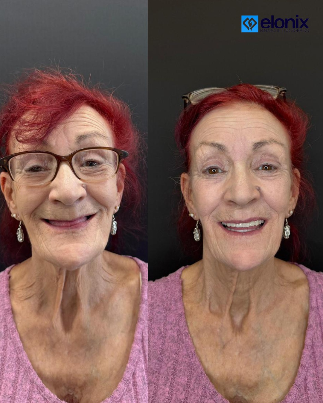 "Prima ➡️ Dopo
Un cambiamento straordinario! La paziente è passata da una situazione senza denti a un sorriso nuovo e naturale. Un risultato che unisce estetica, funzionalità e benessere."👏😍