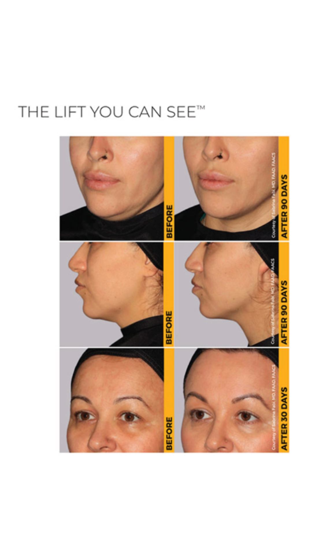 We’re putting the THERAPY in Ultherapy!
Our technicians are making every Ultherapy session unforgettable at ReNew 360.
Reserve your spot and experience it for yourself!
📞 Call: 520-618-0232
➤ Visit: 2732 N. Alvernon Way Tucson, AZ 85712
➤ Visit: http://www.renew360az.com
#ReNew360 #TucsonArizona #Ultherapy