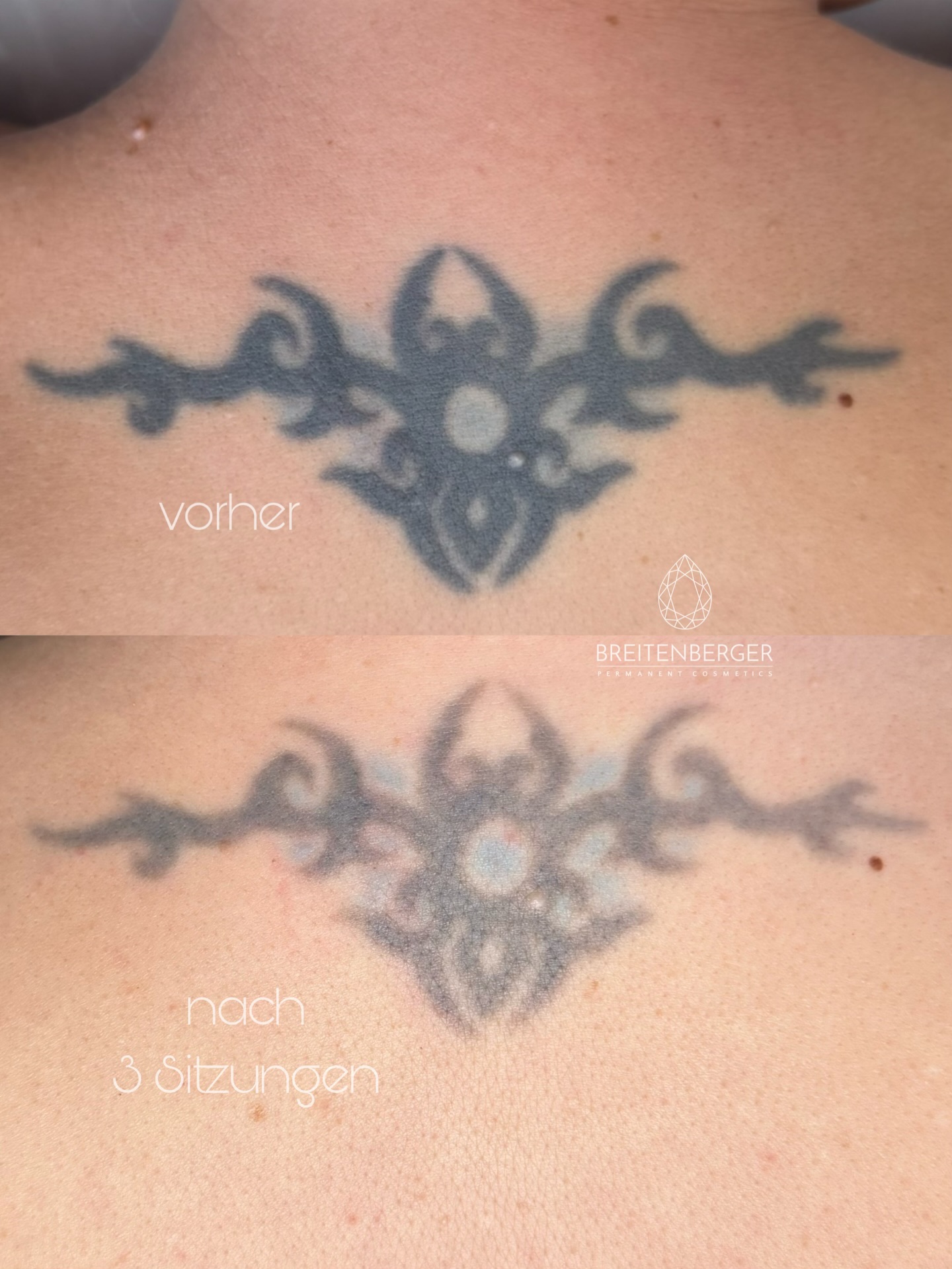 hier sieht man das Ergebnis von drei Laser Sitzungen. Dss Tattoo ist bereits deutlich aufgehellt.
Wie viele Sitzungen nötig sind, hängt immer von mehreren Faktoren ab: Farbe, Pigmenttiefe, Pigmentdichte, Alter des Tattoos und Hauttyp.
Manche Tattoos lassen sich schneller aufhellen, andere brauchen mehr Zeit – weil der Körper die gesprengten Pigmente Schritt für Schritt abbauen muss.
Geduld + die richtige Technik = saubere Entfernung.
Starte jetzt deinen Weg zu reiner Haut und buche online deinen Termin ✨