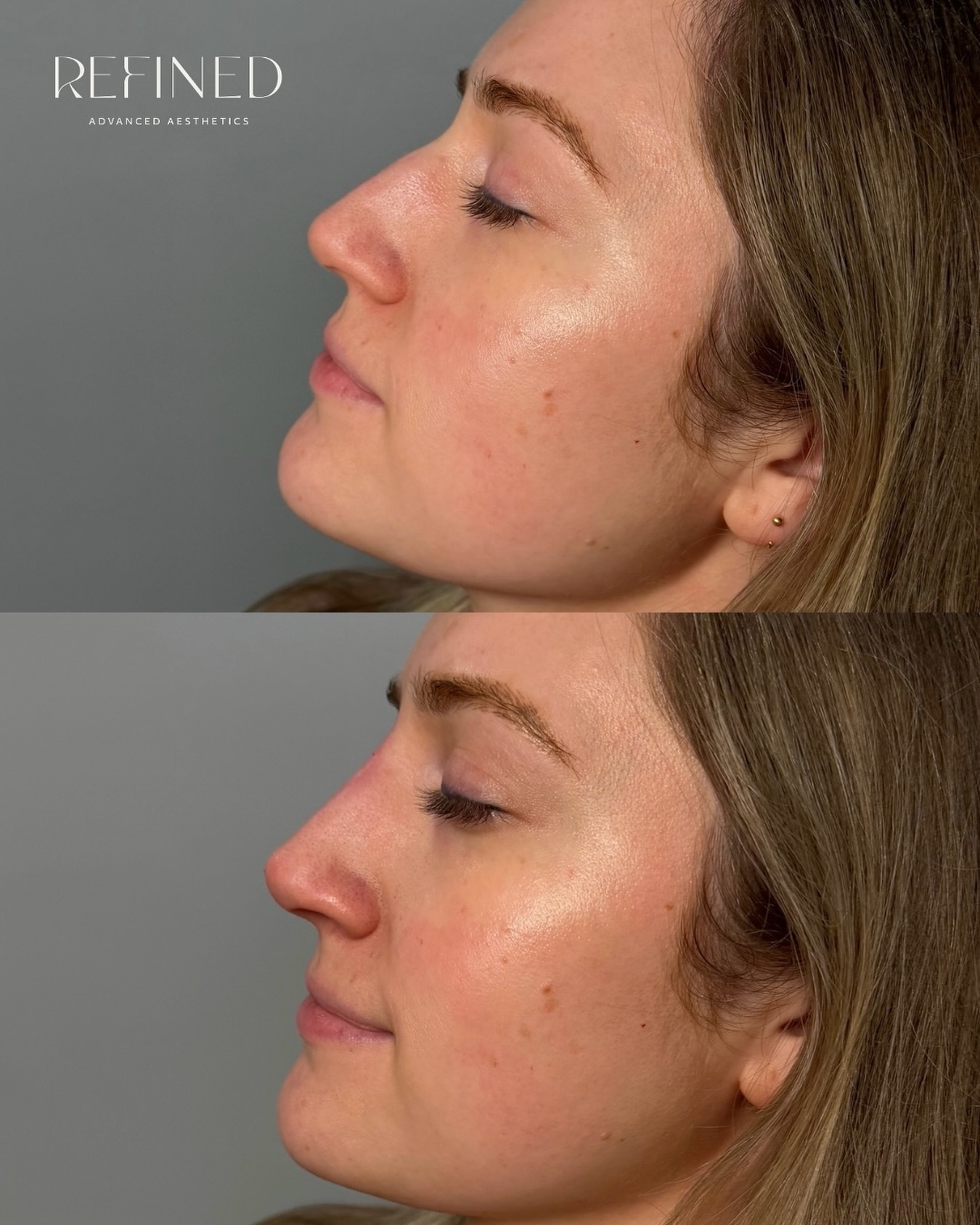 ✨ before & after ✨
Subtle changes, beautiful results.
This non-surgical nose enhancement uses carefully placed filler to smooth irregularities, balance the profile, and enhance natural facial harmony - no surgery required.
Results are immediate with minimal downtime.