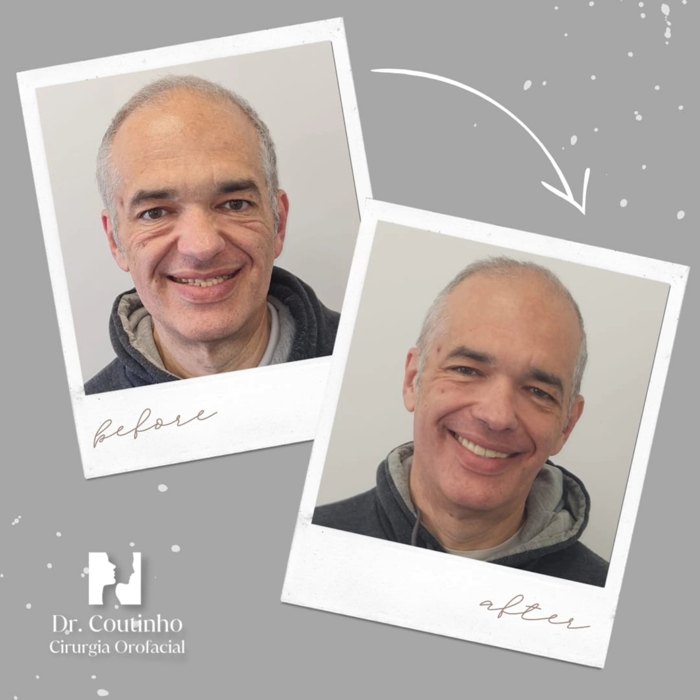 Antes e Depois de Cirurgia Ortognática com Reabilitação Dentária!
✨ Swipe para ver o processo incrível!
👉 Este caso envolve um paciente com prognatismo causado por hipoplasia da maxila e desgaste dentário severo. Esta condição não afeta apenas a estética facial, mas também compromete funções essenciais como mastigação, respiração e fala, além de afetar a autoestima.
➡️ O tratamento realizado: 1️⃣ Cirurgia ortognática para avanço da maxila, corrigindo o alinhamento facial. 2️⃣ Reabilitação dentária com técnica de resinas injetadas, devolvendo forma, função e um sorriso natural.
💡 Por que é tão importante o diagnóstico correto?
Condições como esta exigem a avaliação de um especialista com formação abrangente em patologia dentária, oral e facial. Os Médicos especialista em Estomatologia são os únicos profissionais capacitados a compreender profundamente o desenvolvimento dos maxilares e as condições dentárias associadas, garantindo um plano de tratamento completo e eficaz.
🚨 Sem o diagnóstico preciso e a abordagem correta, o paciente pode enfrentar tratamentos incompletos ou inadequados, comprometendo a função e a estética oral e facial.
🔎 Resultados que vão além da estética: ✔️ Função mastigatória e respiratória restauradas.
✔️ Harmonização facial notável.
✔️ Melhoria na qualidade de vida e confiança do paciente.
✨ Confie no especialista certo para seu tratamento. Cada caso é único e merece ser tratado com precisão e excelência.
📩 Quer saber mais? Tem dúvidas sobre estes tratamentos? Deixe um comentário ou entre em contato!
#CirurgiaOrtognática #Estomatologia #Prognatismo #ReabilitaçãoDentária #Maxila #SorrisoPerfeito #SaúdeOral #AntesEDepois