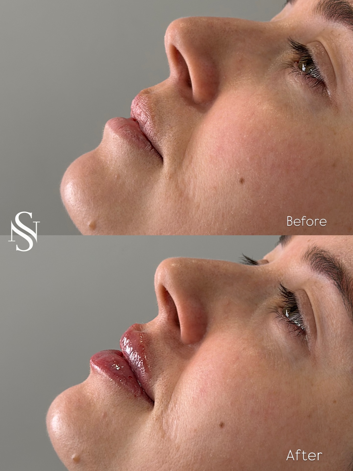 Lip filler isn’t about making lips bigger : it’s about making them better✨🪄
The goal is always:
• harmony with your face
• natural volume
• improved shape and hydration
Every treatment is tailored to enhance what you already have , not to change it.
✨ Subtle tweaks. Big difference.
#surbiton #revolax #lip #fyp
