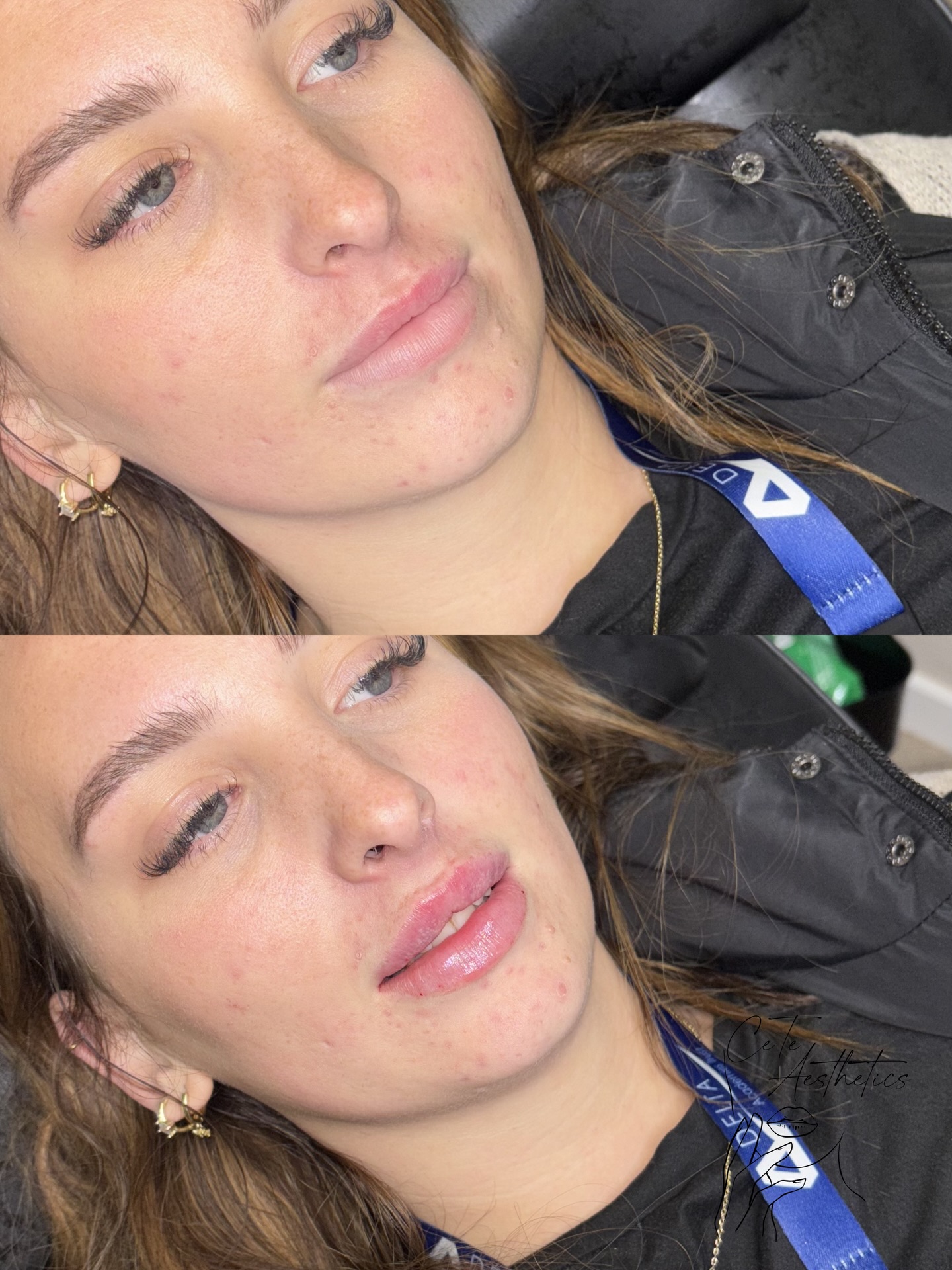 LIP LOVE 🫶🏽💖
Book your appointment online at:
www.ceteaesthetics.co.uk
CeTe Aesthetics | Medical Aesthetics
278 Ashby High Street, Scunthorpe
——
#aesthetic #scunthorpebusiness #aesthetics #lipfillerscunthorpe #nurseledclinic