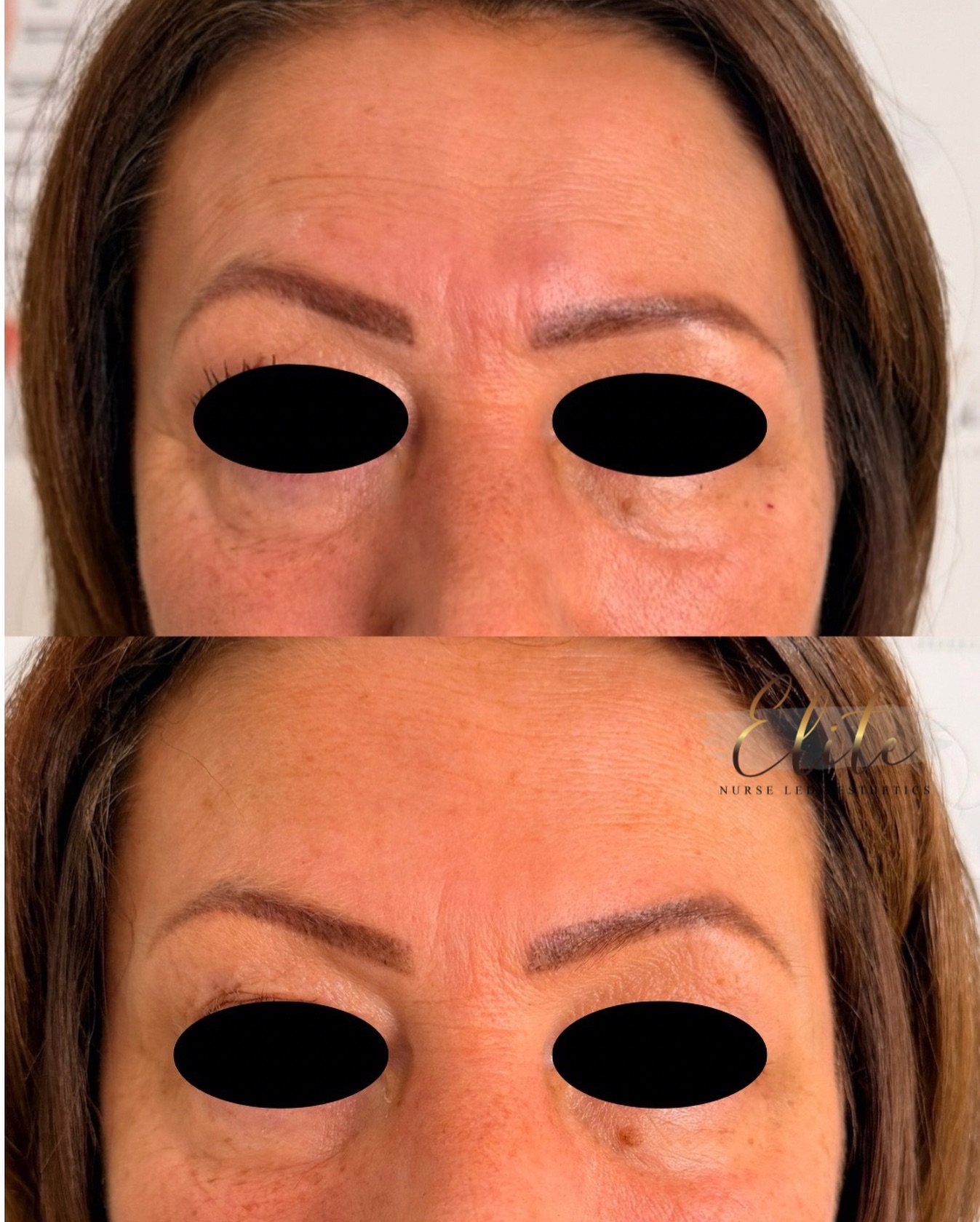 ✨ Brow Symmetry Correction Following Bell’s Palsy ✨
Our lovely client came to us feeling conscious about facial asymmetry caused by previous Bell’s palsy. Her main concern was uneven brow positioning, which was affecting the overall balance of her face.
Using carefully placed wrinkle-relaxing treatment, our experienced Nurse Prescriber was able to subtly lift and balance the brows — creating a more harmonious, symmetrical appearance while maintaining natural facial movement.
The result? A beautifully balanced look and a very happy client 💛
Facial symmetry treatments are never about perfection — they’re about restoring confidence and enhancing what’s already there.
If you have concerns about brow asymmetry or facial imbalance, book a consultation with our medical team to explore your options safely and professionally.
#EliteNurseLedAesthetics
#WakefieldAesthetics
#BrowSymmetry
#BellspalsySupport
#WakefieldClinic