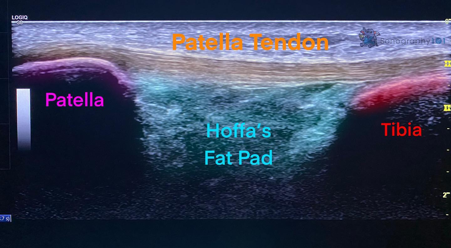 Some MSK Education for you all today 🤗
Infrapatellar Tendon. This image is obtained by scanning anterior to the patella (knee) in sagittal.
.
.
.
.
#ultrasound #sonography #medicalsonography #RDMS #RVT #RegisteredDiagnosticMedicalSonographer #RegisteredVascularTechnologist #UltrasoundTechnologist #Sonographer #UltrasoundTech #Sonography101 #ultrasoundED #ultrasononography #ultrasonographer #Medicine #Medical #Radiology #Radiologia #Ultrasonido #DiagnosticImaging #Medicina #Sonograma
#sonographystudent #sonographyschool