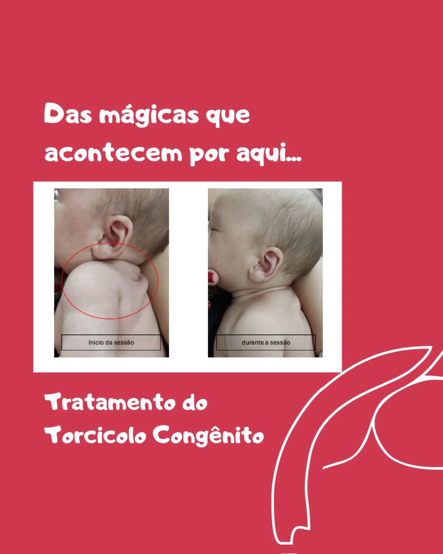 Essa foi somente a primeira sessão.
O bebê segue em tratamento pelas mãos da tia @fisiomartha_bbeatriz
Dra. Martha Batista Beatriz
CREFITO 3 337902-F