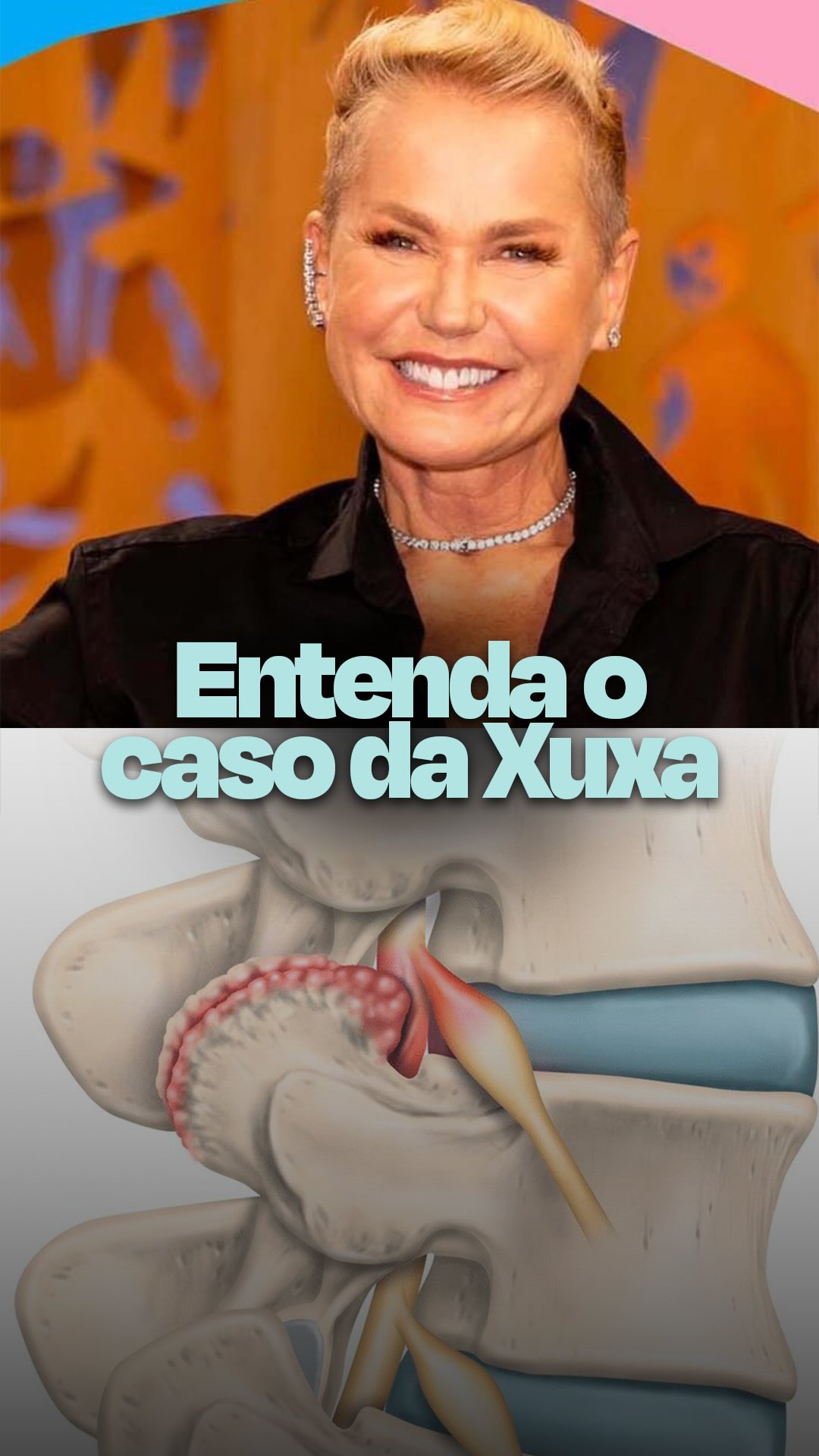 Recentemente, a apresentadora Xuxa foi submetida a um procedimento na coluna para tratar um quadro de estenose foraminal.
Esse problema acontece quando o forame, que é o pequeno canal por onde saem as raízes nervosas da coluna, começa a se estreitar. Quando isso ocorre, o nervo pode ficar comprimido, provocando sintomas como dor ciática, dor que irradia para as pernas, formigamento ou desconforto constante na região lombar, glúteo e pernas.
No caso da apresentadora, as dores eram frequentes e estavam impactando sua qualidade de vida, o que levou à indicação de tratamento cirúrgico - realizado por técnica endoscópica (por vídeo).
Hoje, muitos desses casos podem ser tratados com técnicas minimamente invasivas ou endoscópicas, que utilizam pequenas incisões, causam menos agressão aos tecidos e permitem uma recuperação mais rápida para o paciente.
👉 Se você também sofre com dor ciática ou dores constantes na coluna que atrapalham o seu dia a dia, procure avaliação com um especialista em coluna para investigar a causa e definir o melhor tratamento.
#EstenoseForaminal
#DorCiática
#SaudeDaColuna
#CirurgiaDaColuna
#ColunaVertebral
Ortopedia
CirurgiaMinimamenteInvasiva
EspecialistaEmColuna