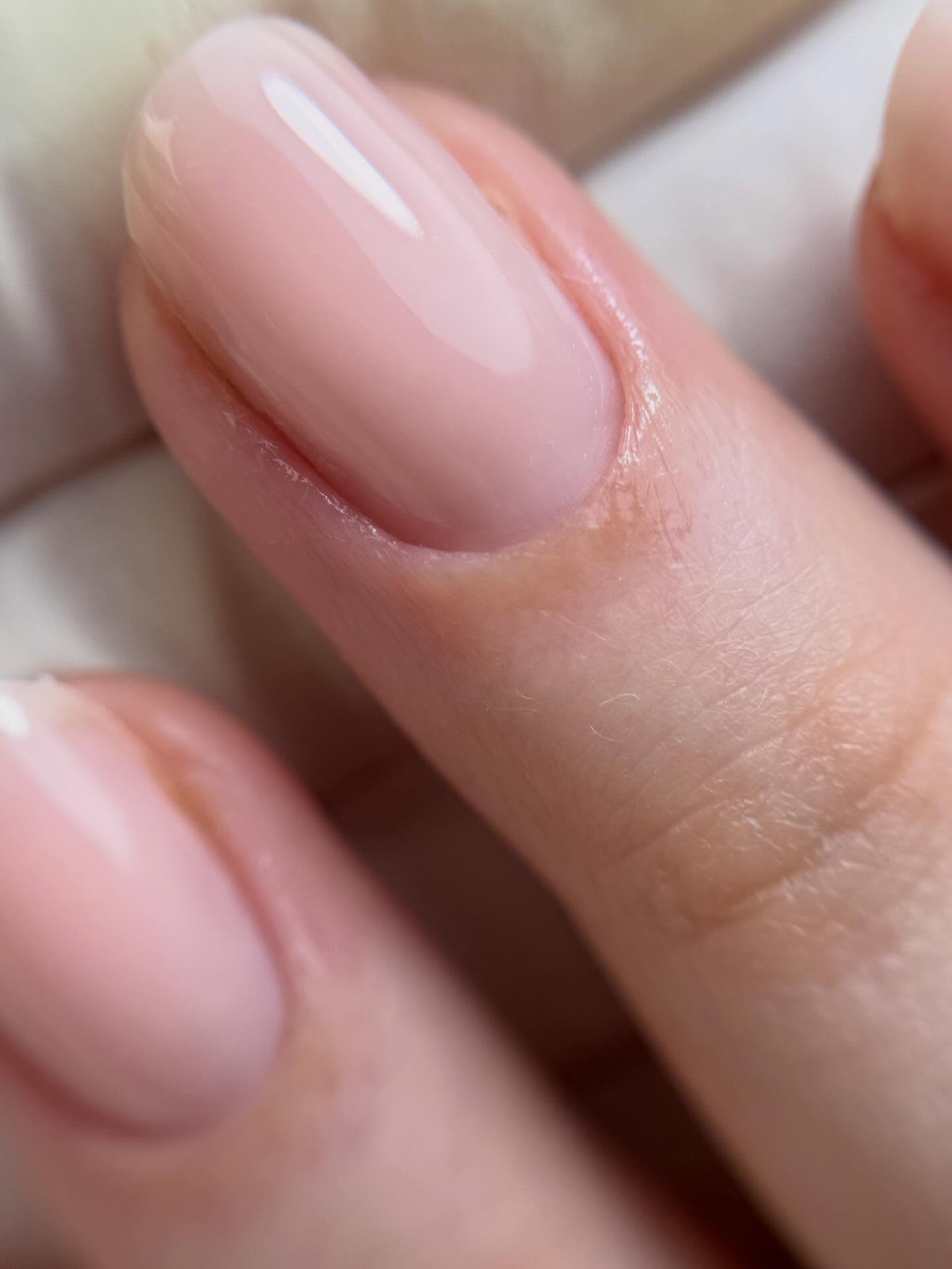 Builder gel doesn’t need to be thick to be strong.
One of the most common misconceptions I see is that thicker product means stronger nails or better retention.
In reality, strength comes from correct structure, not excessive product.
When builder gel is applied correctly, the apex supports the nail and distributes pressure across the structure without creating unnecessary bulk.
Excessively thick applications don’t improve performance. Instead, they can lead to:
-Bulky, unbalanced nails
-Excessive filing during rebalances
-Difficulty during removal
-And in some cases, curing issues
When product is applied too thickly, the lamp may struggle to cure it evenly all the way through. This can increase the risk of undercured product, which means a higher chance of exposure to uncured acrylates.
Repeated exposure to uncured product is one of the key factors behind the development of gel allergies.
Builder gel is designed to reinforce the natural nail, not bury it under unnecessary layers.
Thin, controlled application combined with correct structure will always outperform excessive thickness.
Strength comes from technique, not bulk.
Understanding these fundamentals is essential for protecting both the natural nail and long-term client safety.
Link in bio for my professional training.