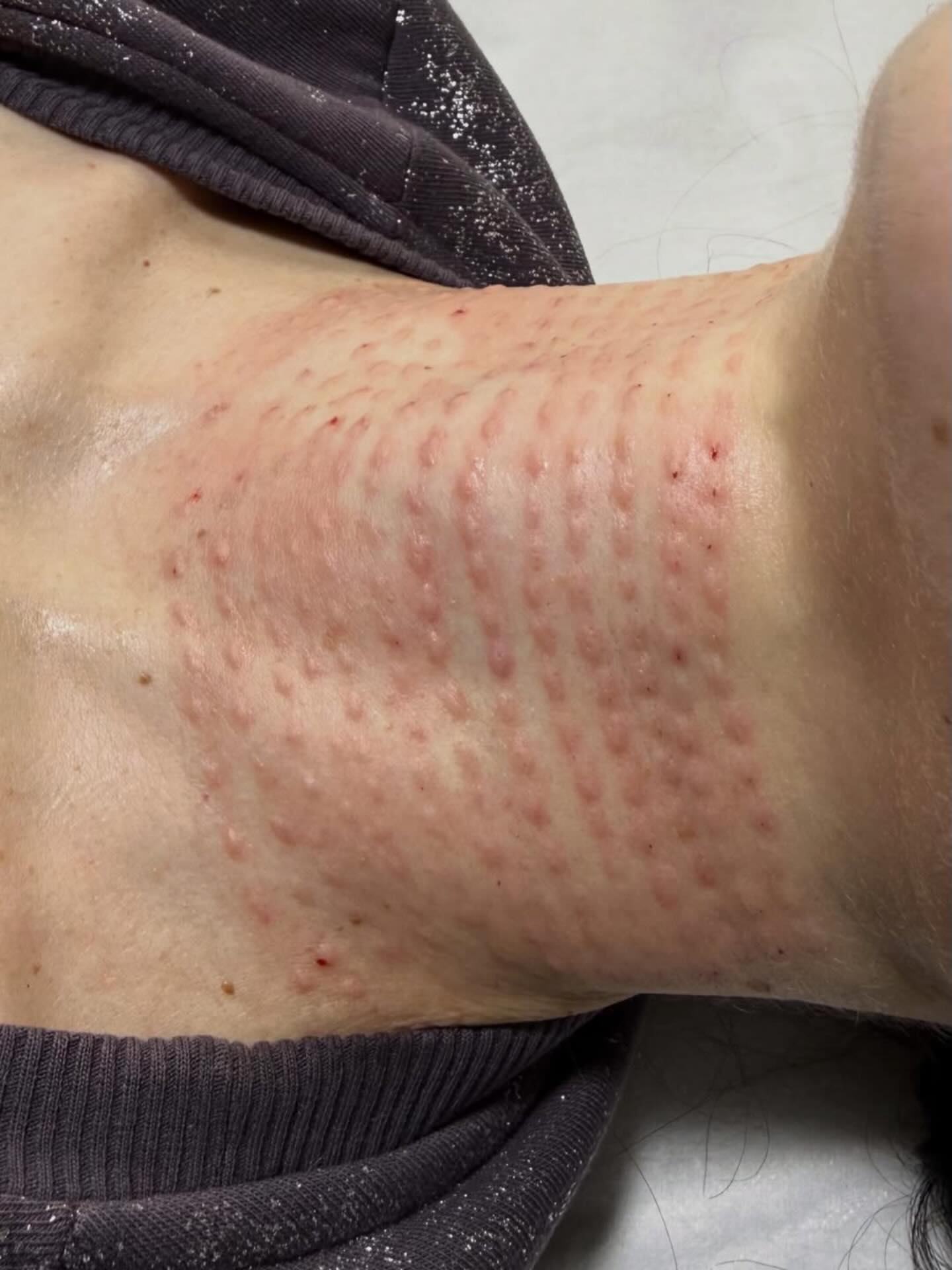 Biorevitalisierung der empfindlichen Halszone
Sieht erstmal etwas erschreckend aus? 😅
Keine Sorge – das ist völlig normal und gehört zur Behandlung dazu.
Die Biorevitalisierung ist eine moderne Injektionsbehandlung in der ästhetischen Medizin, die die Haut intensiv mit Feuchtigkeit versorgt und ihre Qualität sichtbar verbessert.
Dabei werden Präparate auf Basis von Hyaluronsäure in die Haut injiziert. Diese kommt natürlicherweise in unserem Körper vor und spielt eine wichtige Rolle für Hydration, Elastizität und Spannkraft der Haut.
Mit zunehmendem Alter nimmt die körpereigene Produktion von Hyaluronsäure ab. Genau hier setzt die Biorevitalisierung an:
Sie versorgt die Haut gezielt mit Feuchtigkeit in den tieferen Hautschichten und aktiviert gleichzeitig die natürlichen Regenerationsprozesse.
✨ Ergebnis:
• intensive Hydration
• mehr Elastizität und Spannkraft
• glattere Hautstruktur
• frischeres und jüngeres Hautbild
Der Hals ist eine besonders empfindliche Zone – deshalb verdient er genauso viel Pflege wie das Gesicht.
#deincosmetologist #beauty #rottenburgamneckar #botox #biorevitalisierung