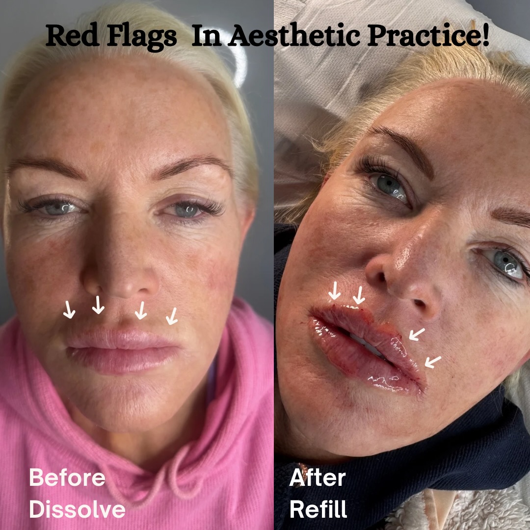 Dissolving filler is one of the most important safety tools in aesthetic medicine, if your practitioner has not included this in your long term patient journey this is a 🚩
Not every concern needs more volume.
Sometimes restoring natural anatomy means resetting and starting again, practitioners should have confidence and skill in dissolving as needed for their patients to maintain natural results 💋
Ethical practitioners should always:
• Recognise filler migration
• Correct overfilling
• Prioritise facial balance
• Be confident using hyaluronidase when needed
Good aesthetics isn’t about adding more… it’s about knowing when to stop.
At @ultra_academy_uk we teach practitioners to:
• Assess previous filler correctly
• Identify migration
• Use hyaluronidase safely
• Create long-term facial harmony
Good injectors add filler.
Great injectors know when to dissolve.
Follow @ultra_aesthetics_ for more tips on aesthetic medicine 💉
#aestheticclinic #skinclinic #lip #lipfillers #lipfiller