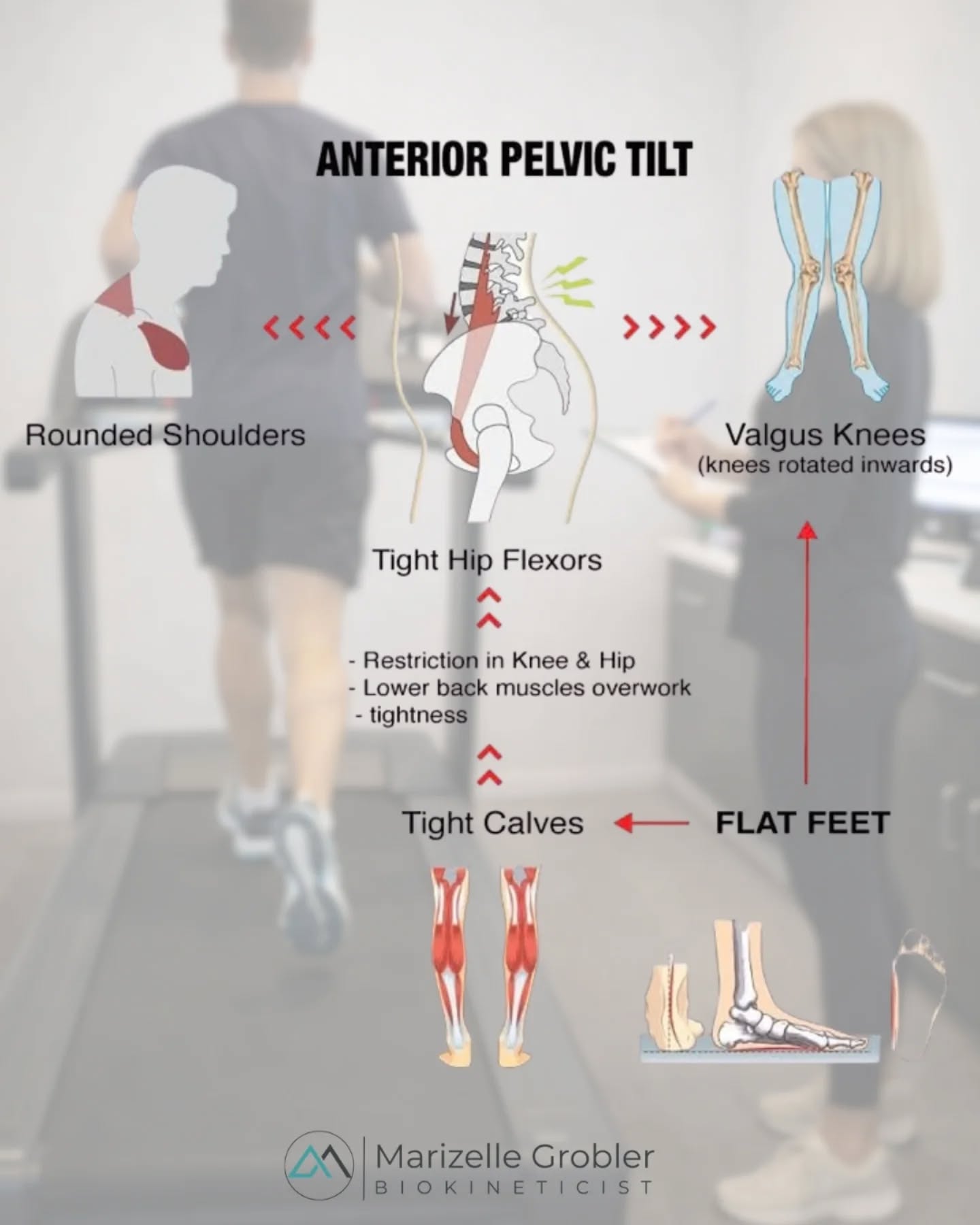 Anterior Pelvic Tilt – The Posture Problem Many People Don’t Realise They Have
Ever noticed a lower back that always feels tight…
A stomach that seems to stick out even when you're fit…
Or glutes that just don’t seem to activate properly?
It might not be weakness.
It might be an anterior pelvic tilt.
Anterior pelvic tilt happens when the pelvis rotates forward, increasing the arch in the lower back. Over time, this posture changes how muscles work and how the body moves.
What can it cause?
• Lower back pain
• Tight hip flexors
• Weak or inactive glutes
• Core dysfunction
• Hamstring tightness
• Poor posture and movement patterns
• Hip and knee pain
• A stomach that protrudes forward
When the pelvis sits in the wrong position, the body starts compensating. Muscles that should work become lazy, while others become overworked and tight.
The result? Pain, inefficient movement, and frustration when exercise doesn’t seem to help.
The good news:
Anterior pelvic tilt is very treatable.
With the right combination of: ✔ posture correction
✔ glute activation
✔ core strengthening
✔ mobility work
the pelvis can return to a more neutral position and movement patterns can improve dramatically.
Sometimes the pain you feel is only the symptom…
The real problem is the alignment and muscle imbalance underneath it.
This is why proper assessment and targeted rehabilitation matters.
Your body works as a system — and when we correct the root cause, everything starts working better.
#PostureCorrection #Biokinetics #MovementMatters #LowerBackPain #InjuryPrevention FunctionalMovement