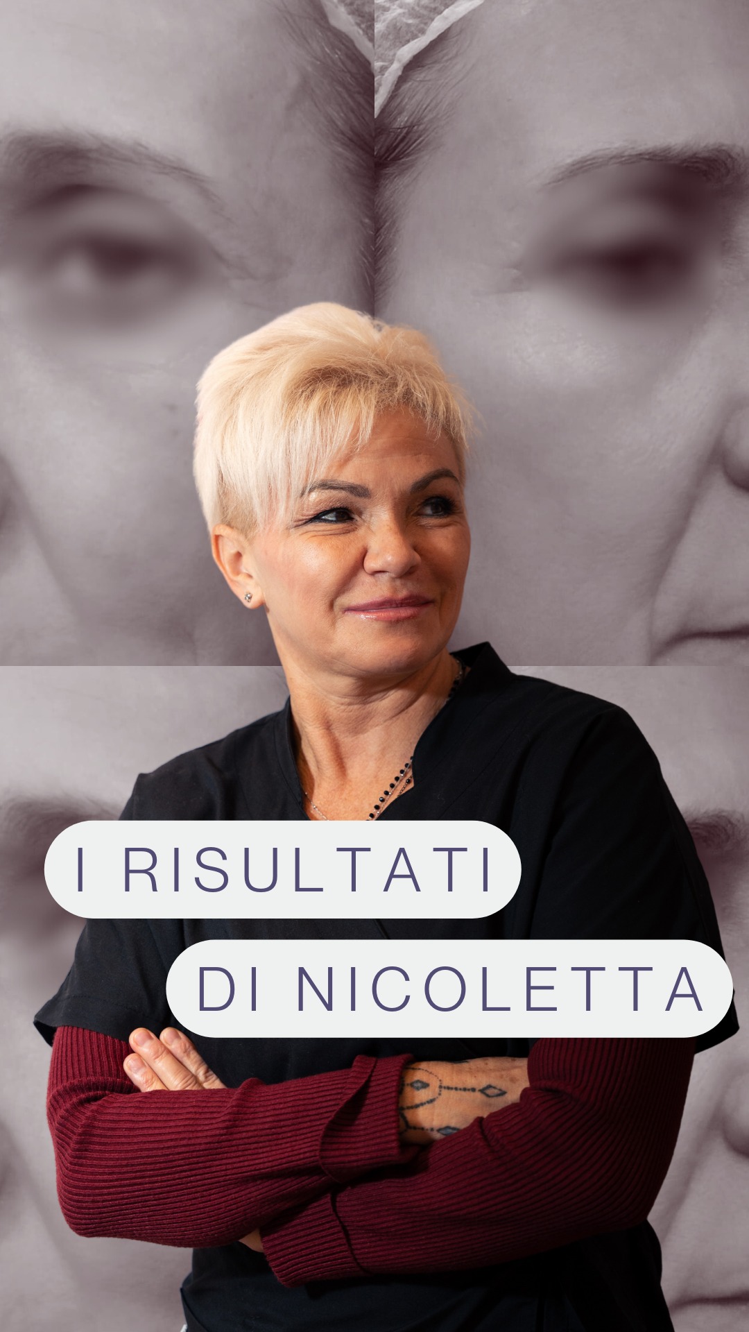 Il melasma è una forma di iperpigmentazione della pelle: è caratterizzata dalla comparsa di macchie scure (marroni o grigio-marroni) soprattutto sul viso.
Con il trattamento dermamelan® di mesoestetic® nel nostro Centro riusciamo ad avere dei risultati straordinari, e prova ne è la trasformazione di Nicoletta, di cui potete vedere i prima e dopo nel video!
.
.
.
Prenota il tuo appuntamento di benessere presso Centro Riabilitativo Psico Fisico di Motta di Livenza chiamandoci al 📞0422766896 o scrivendo su whatsapp al 3887974760