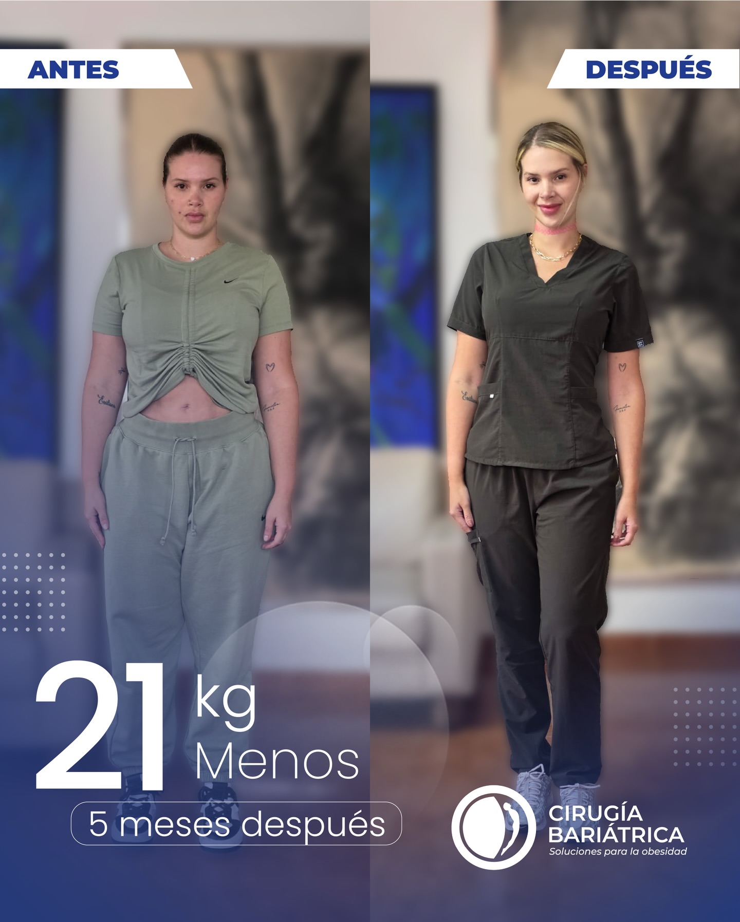 Una nueva vida en solo 5 meses. ✨
Nuestra paciente logró bajar 21 kg gracias a la cirugía bariátrica realizada por el Dr. Eduardo Bolaños y su equipo de especialistas. Un proceso que no solo transforma el cuerpo, sino que también mejora la salud, la energía y la calidad de vida.
Cada historia es un recordatorio de que con la guía correcta, la tecnología adecuada y un equipo médico comprometido, los cambios reales son posibles. 💙
A life-changing transformation in just 5 months. ✨
Our patient lost 46 lbs thanks to bariatric surgery performed by Dr. Eduardo Bolaños and his highly experienced team. This journey is not only about weight loss, but also about improving health, confidence, and overall quality of life.
With the right medical guidance, advanced technology, and a dedicated team, real and lasting change is possible. 💙
#bariatrica #bariatricsurgery #health #bajardepeso #weightlosssurgery