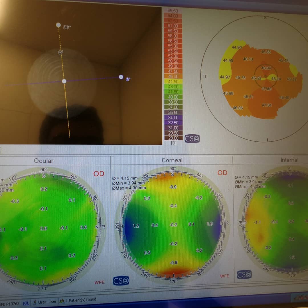 Diffractive Pattern of a Trifocal Toric IOL as seen by Peramis Aberrometer :)