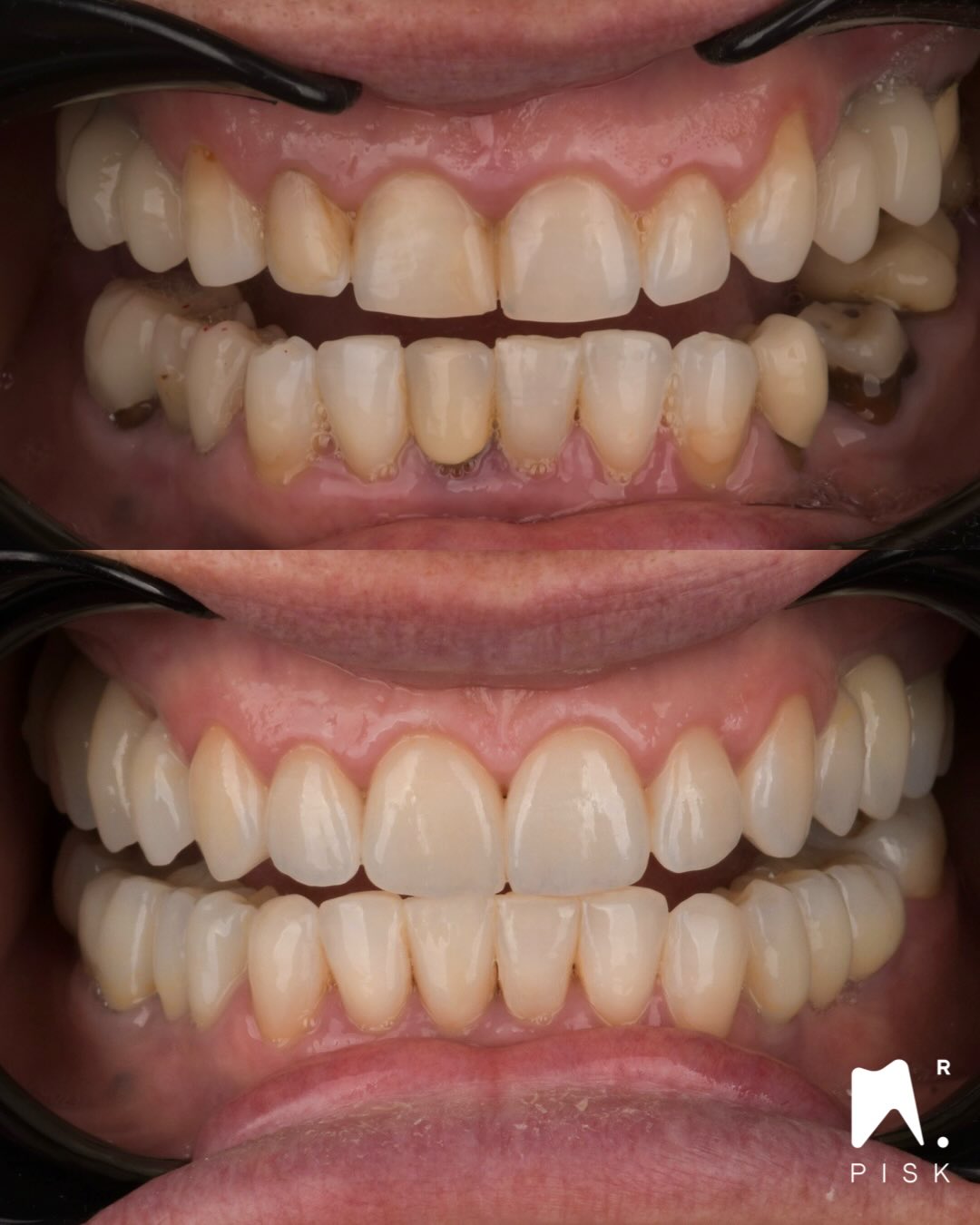Global treatment with my team !
Thx @smilecloud_biometrics for the design
Thx @guillaume_sabathier for ceramics
Thx @erchmmd for lift sinus and implants
Thx @dr.honoreztheo for retreatments