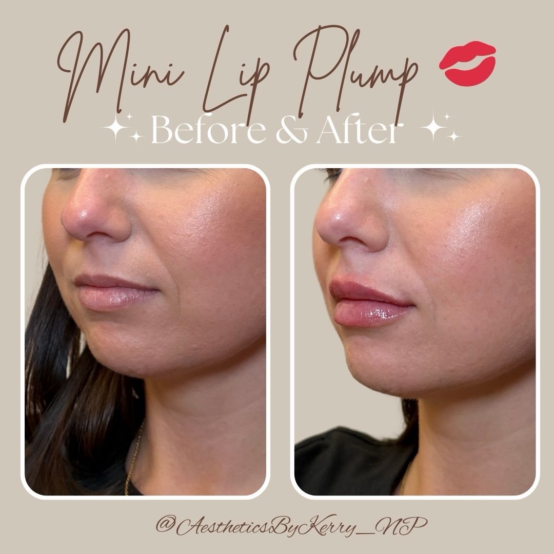 Beautiful lips… just refined. ✨
Lip filler isn’t about making lips look different — it’s about enhancing the shape, restoring hydration, and creating balance. 💋
Subtle volume.
Defined borders.
Naturally beautiful results.
📍Book your consultation today! Link available in bio!
.
.
.
#lipfillerresults #liphydration #injectables #evolysse #juicylips