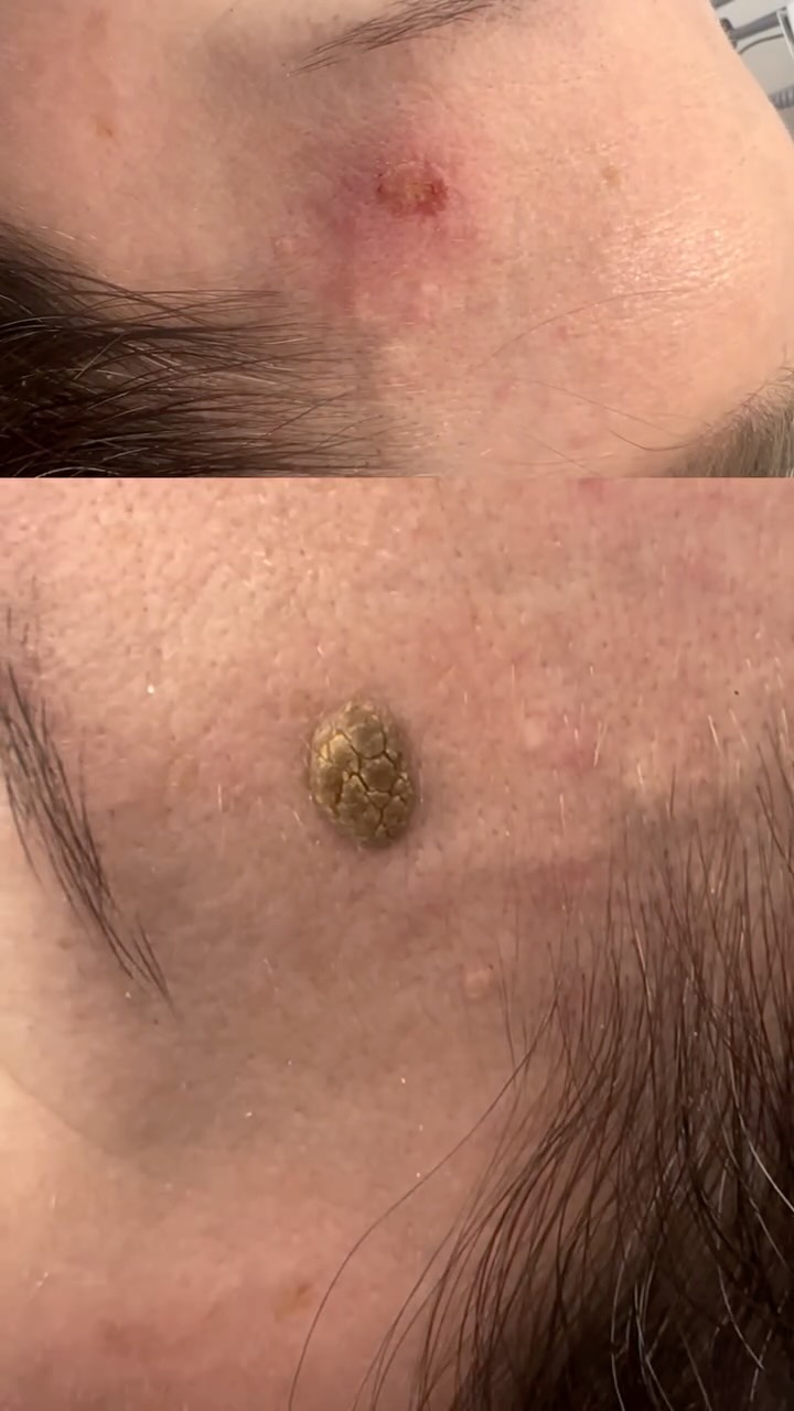 Key Facts About Seborrheic Keratosis
Not Cancerous: SKs are not skin cancer, nor do they turn into it.
Appearance: They can be smooth or rough, waxy, and range in color from light tan to black. They often look as if they were "pasted" or "stuck" onto the skin.
Location: Common on the face, neck, chest, and back; they do not appear on palms or soles.
Symptoms: Generally asymptomatic, but can itch, become inflamed, or bleed if irritated by clothing.
Causes: The exact cause is unknown, but they are strongly linked to aging, genetics, and potentially sun exposure.
Treatment: these can easily be removed using a plasma pen.
#trowbridge #warminster #westbury #frome #hilperton