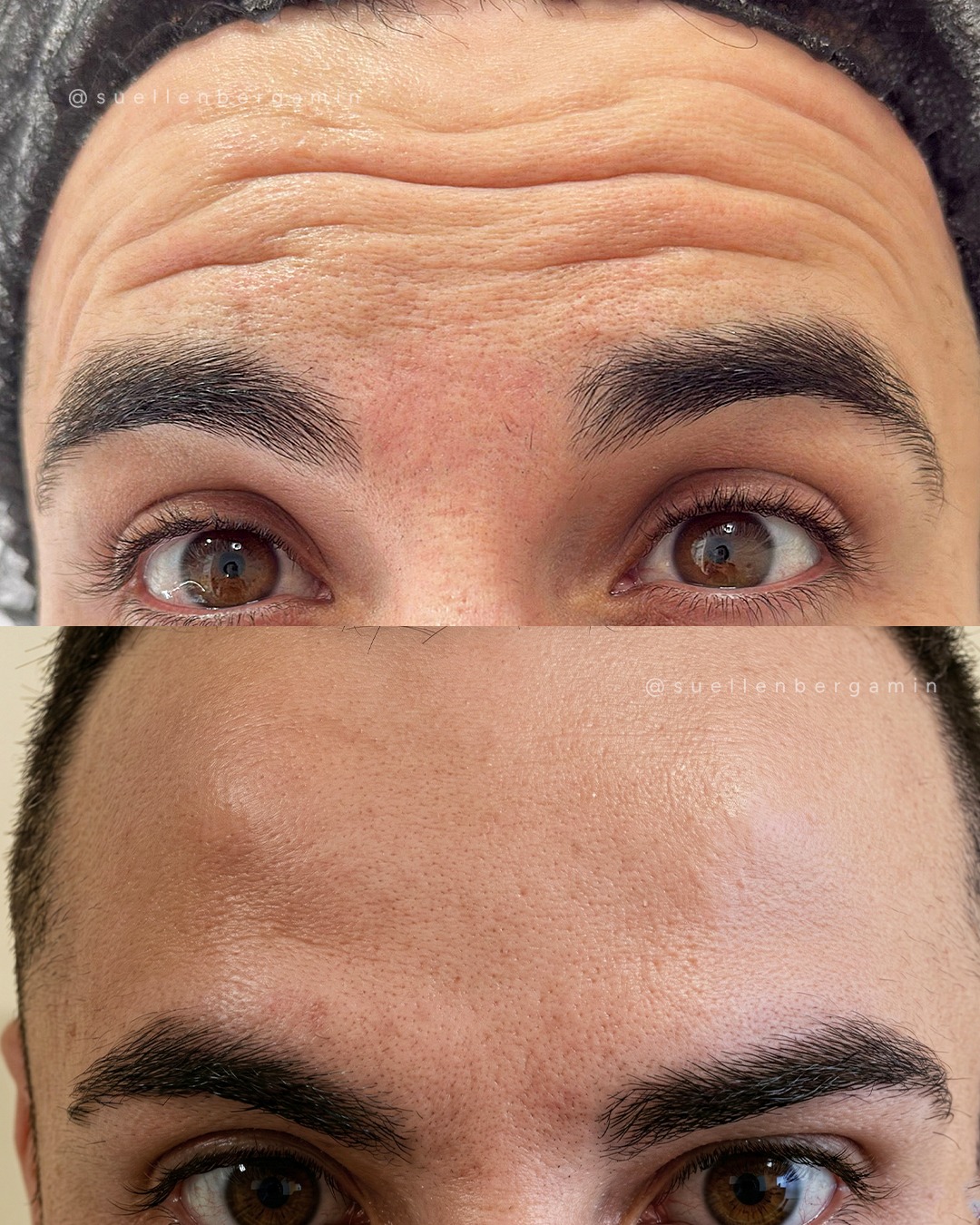 1 semana depois… e olha esse resultado maravilhoso! 😍
Sim, botox também é para homens — e o resultado pode ser incrível quando feito com naturalidade.
As linhas de expressão ficam suavizadas, o rosto ganha um aspecto mais descansado e a aparência continua masculina, apenas mais leve e rejuvenescida. ✨
Cuidar da pele não tem gênero.
Tem a ver com autoestima, bem-estar e se sentir bem ao se olhar no espelho.
E esse resultado de apenas 7 dias mostra bem isso! 👏
Quer saber se o botox é para você também?
Me chama e vamos conversar. 💬
.
1 week later… and look at this amazing result! 😍
Yes, Botox is for men too — and the results can be incredible when done naturally.
Expression lines become softer, the face looks more rested, and the appearance remains masculine, just lighter and more rejuvenated. ✨
Taking care of your skin has no gender.
It’s about self-esteem, well-being, and feeling good when you look at yourself in the mirror.
And this result after just 7 days shows exactly that! 👏
Want to know if Botox could be right for you too?
Send me a message and let’s talk. 💬
