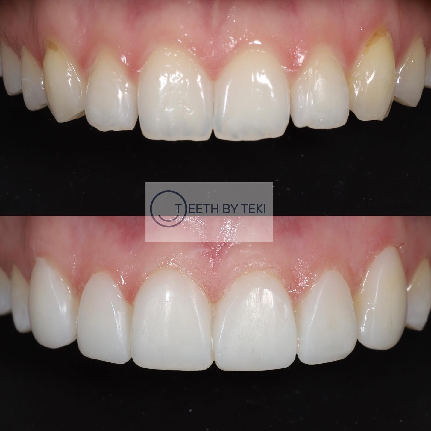 One of my faves ⚪️💙
.
.
Composite bonding on 6 teeth after Invisalign 🥶
.
.
For prices see our website and to book please email book@teethbyteki.com
.
.
#teethbyteki #compositebonding