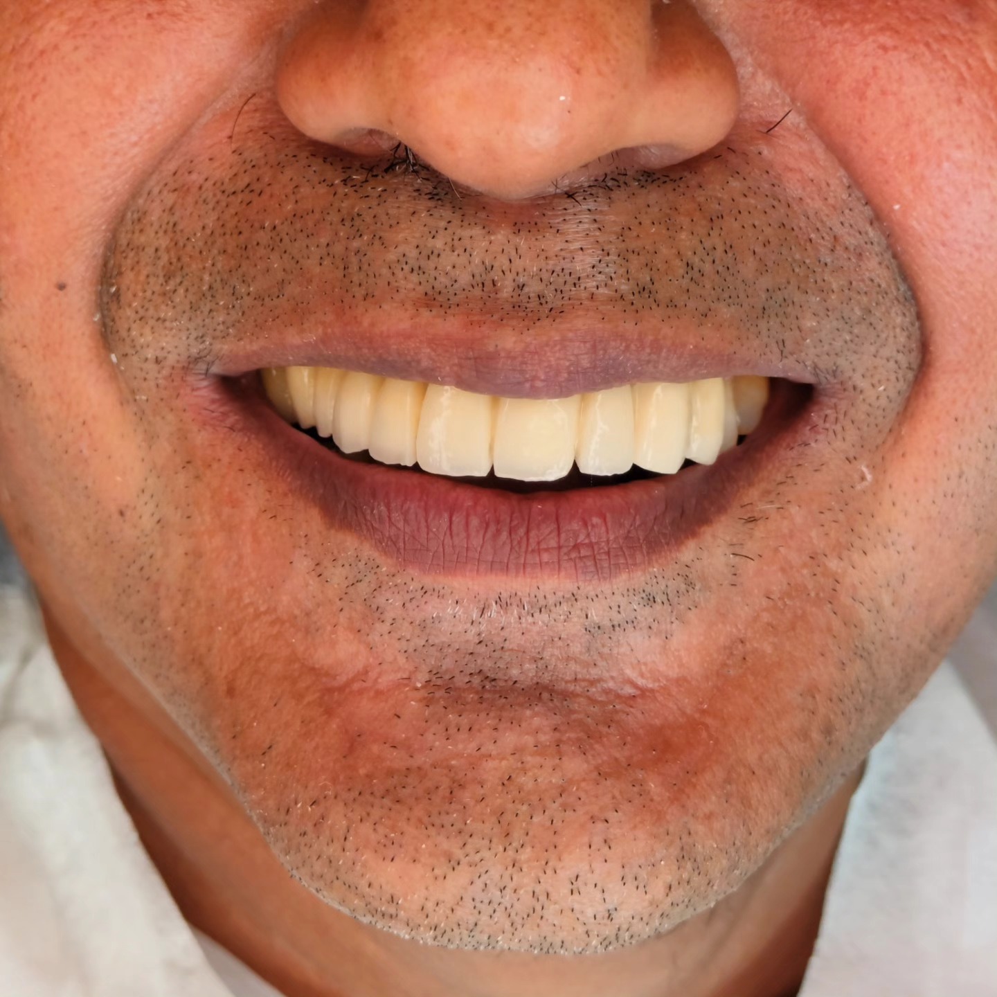 Transformation of a patient that's made possible using proper planning.
Precise pleasant and Aesthetic Dentistry by Dr. Sethuraman Ramadoss
SETHU'S DENTAL HOUSE
04442137362 | 9962395200
#dmls #implant #dentalimplants