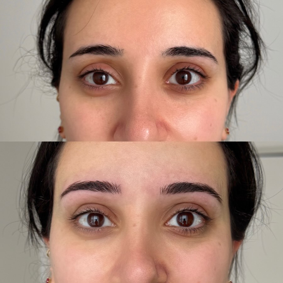 Grรขce aux diffรฉrentes techniques offertes, il est possible de redรฉfinir la ligne naturelle du sourcil et de crรฉer une structure harmonieuse adaptรฉe aux traits du visage, afin dโobtenir des sourcils plus fournis, structurรฉs et dรฉfinis, avec un effet liftant qui met en valeur votre visage et vos traits.
Des sourcils bien dessinรฉs et adaptรฉs ร la morphologie du visage apportent souvent un effet rรฉveillรฉ au regard, faisant toute la diffรฉrence.
Chaque procรฉdure est entiรจrement personnalisรฉe selon la morphologie de votre visage. Le sourcil est crรฉรฉ sur mesure et dessinรฉ exclusivement pour vous, selon le rรฉsultat souhaitรฉ, combinรฉ ร nos conseils et ร notre expertise.
๐ Plateforme de prise de rendez-vous disponible dans notre bio
๐ฉ Vous pouvez tout simplement nous envoyer un message
๐ Ou nous contacter par tรฉlรฉphone pour plus dโinformations
๐๐๐ซ๐๐ก & ๐๐ค๐ฃ๐ฉ๐ง๐๐๐ก ๐๐๐๐ง๐ค๐๐ก๐๐๐๐ฃ๐ / ๐พ๐ค๐จ๐ข๐๐ฉ๐๐ ๐ฝ๐ง๐ค๐ฌ ๐๐๐ฉ๐ฉ๐ค๐ค / ๐๐๐ฃ๐ค ๐ฝ๐ง๐ค๐ฌ๐จ / ๐๐๐ง๐ข๐๐ฃ๐๐ฃ๐ฉ ๐๐๐ ๐๐ช๐ฅ / ๐๐๐จ๐๐ก๐๐๐ฉ & ๐ฝ๐ง๐ค๐ฌ ๐ก๐๐ข๐๐ฃ๐๐ฉ๐๐ค๐ฃ / ๐๐๐จ๐ฉ๐๐ง๐๐ก๐๐จ๐จ๐๐จ / ๐ญ:๐ญ ๐๐ง๐๐๐ฃ๐๐ฃ๐
#NanoBrowsLaval
#NanoBrowsMontreal
#browslaval
#permanentmakeuplaval
#LavalBrows
pmulaval