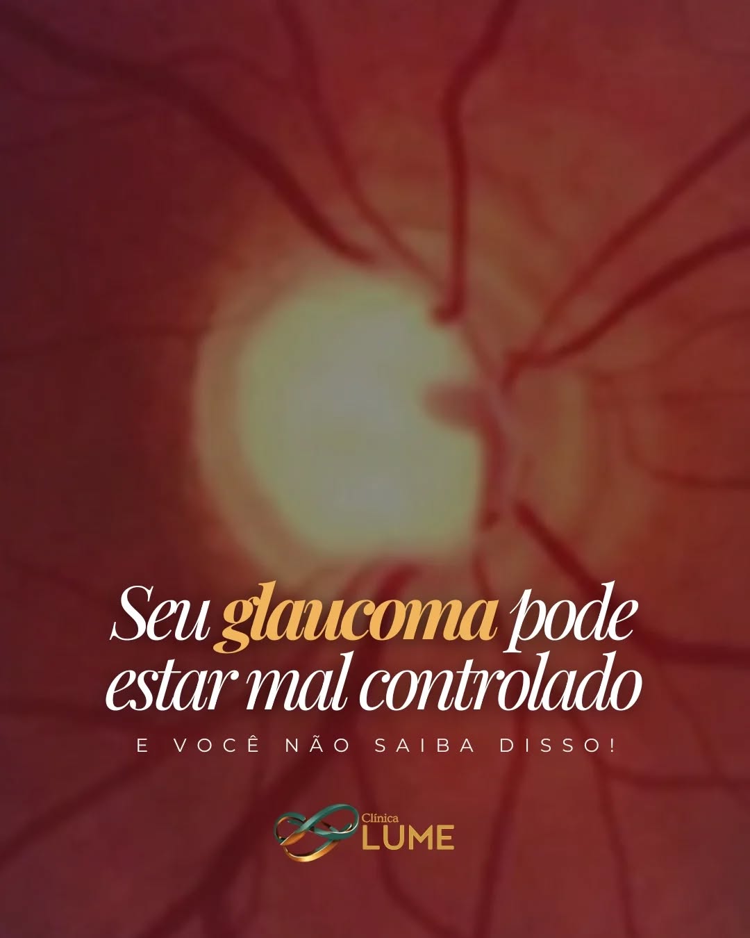 🔎 Glaucoma: a doença silenciosa da visão
O glaucoma é uma das principais causas de cegueira no mundo — e muitas vezes não causa sintomas no início.
⚠️ Sinais de alerta
Na maioria dos casos, o glaucoma não dá sinais no começo. Quando sintomas aparecem, pode haver:
• perda da visão periférica (visão lateral)
• dificuldade para enxergar em ambientes escuros
• visão em túnel nos estágios mais avançados
👁 Quem deve ficar mais atento?
• pessoas acima de 40 anos
• histórico de glaucoma na família
• pressão intraocular elevada
• miopia alta ou algumas doenças sistêmicas
🩺 Como é feito o diagnóstico?
O diagnóstico é realizado no exame oftalmológico, que pode incluir:
• medida da pressão ocular
• exame do nervo óptico
• campo visual
• exames de imagem do nervo óptico (OCT)
✔️ A boa notícia:
Quando diagnosticado precocemente, é possível controlar o glaucoma e preservar a visão.
📅 Consulte seu oftalmologista regularmente